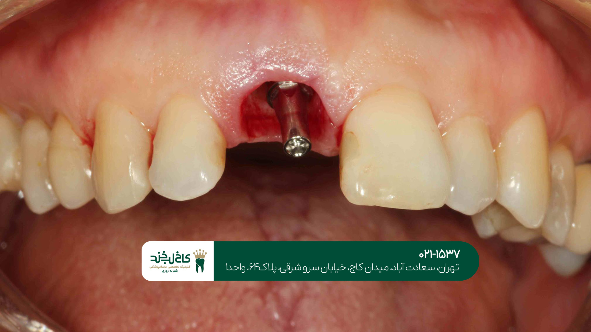 مهمترین مراقبت بعد از ایمپلنت دندان مهمترین مراقبت بعد از ایمپلنت دندان