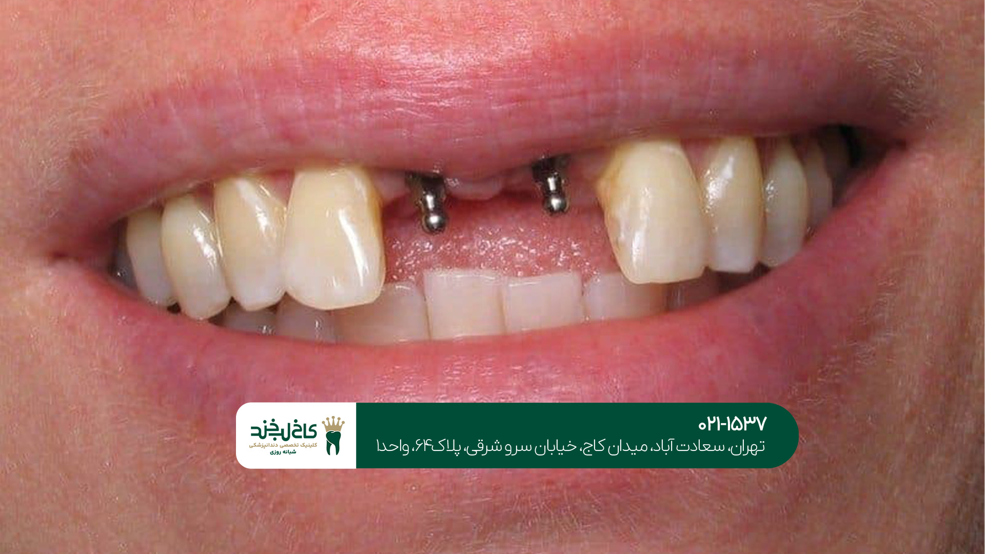 مهمترین مراقبت بعد از ایمپلنت دندان مهمترین مراقبت بعد از ایمپلنت دندان