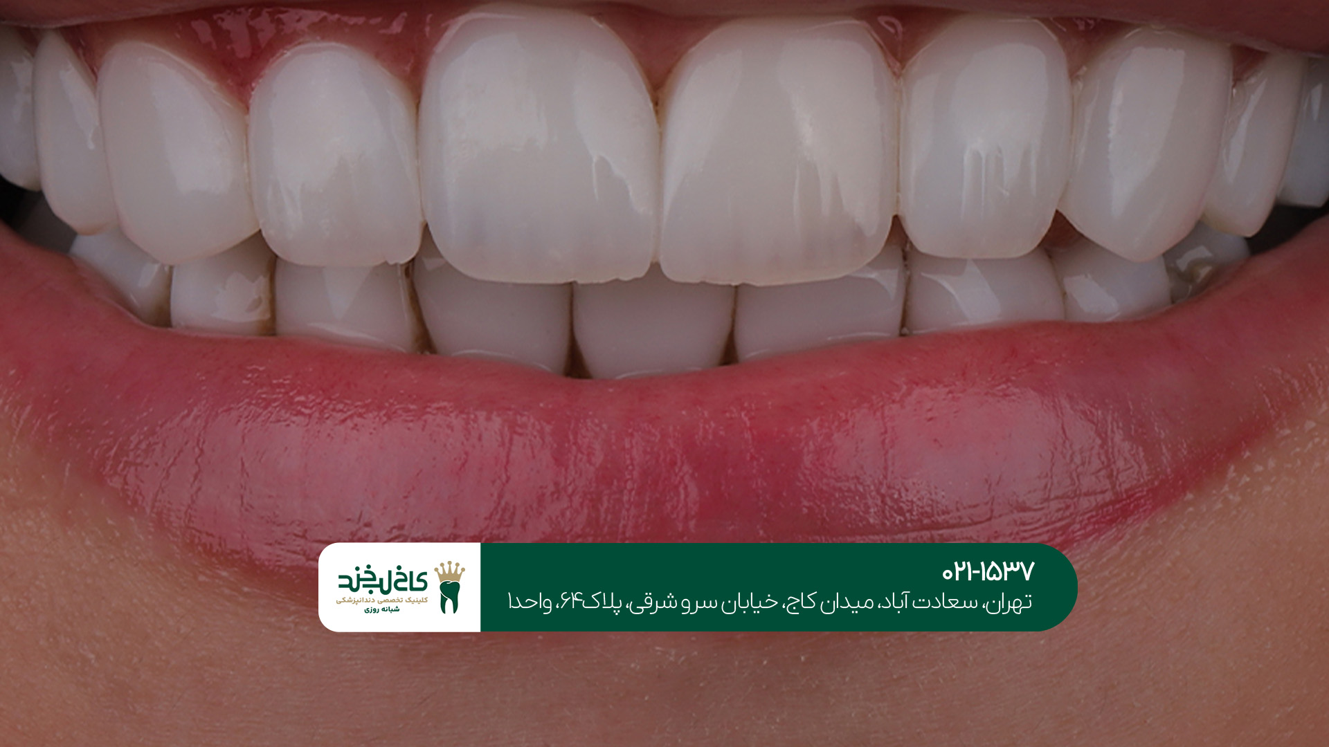 مواد مورد استفاده در کامپوزیت مواد مورد استفاده در کامپوزیت