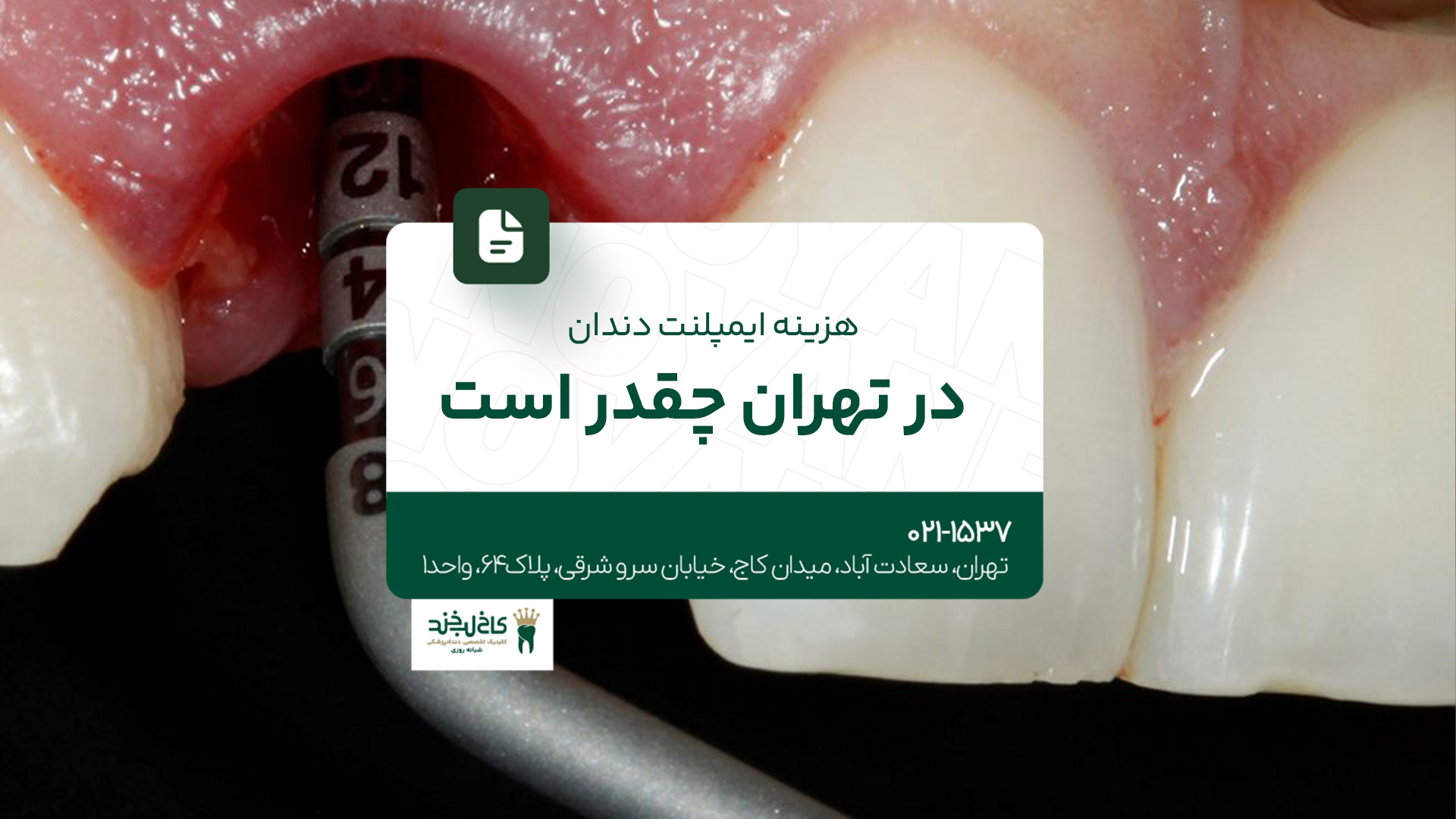 هزینه ایمپلنت دندان در تهران چقدر است؟
