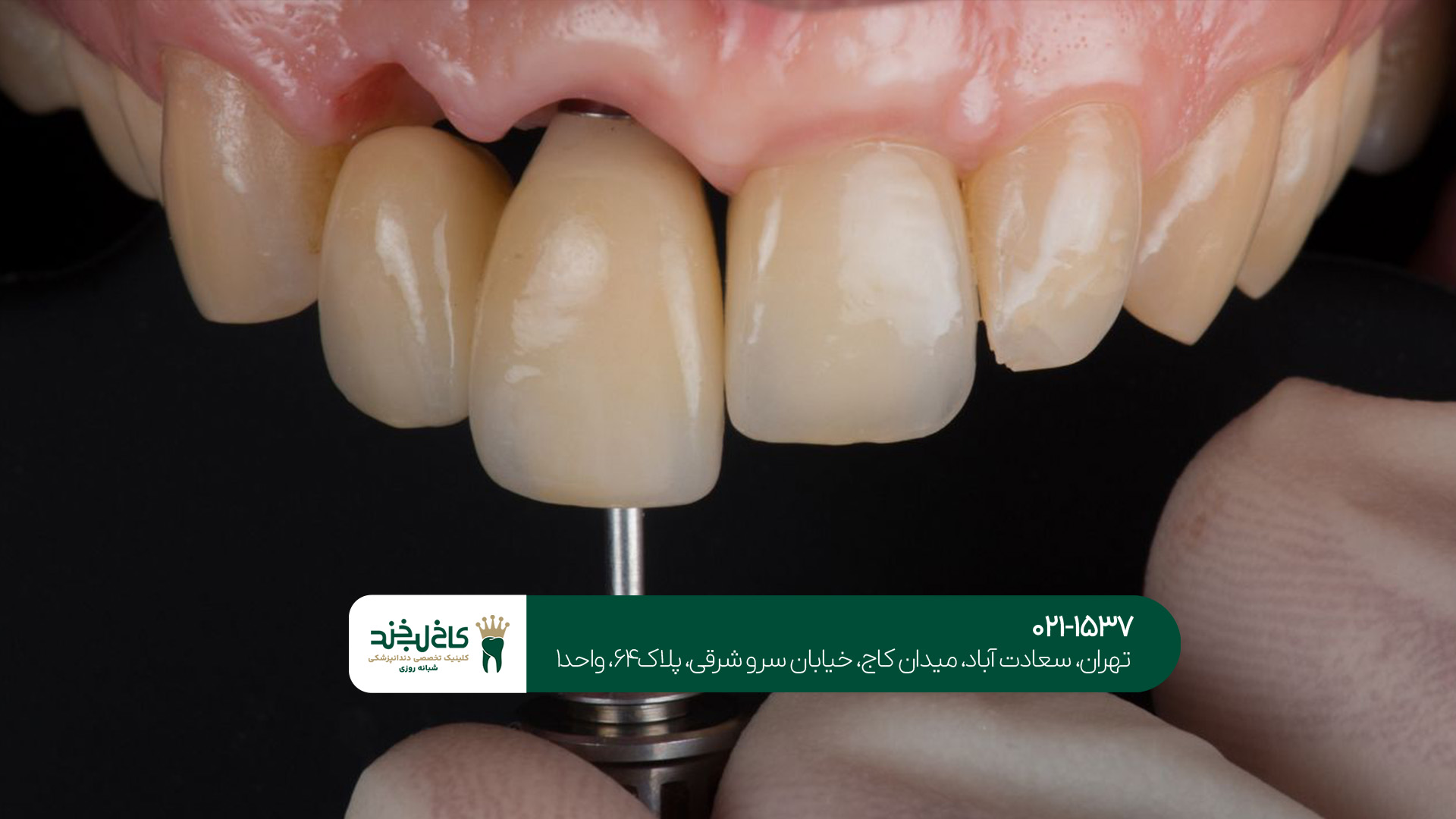 هزینه ایمپلنت دندان در تهران چقدر است؟