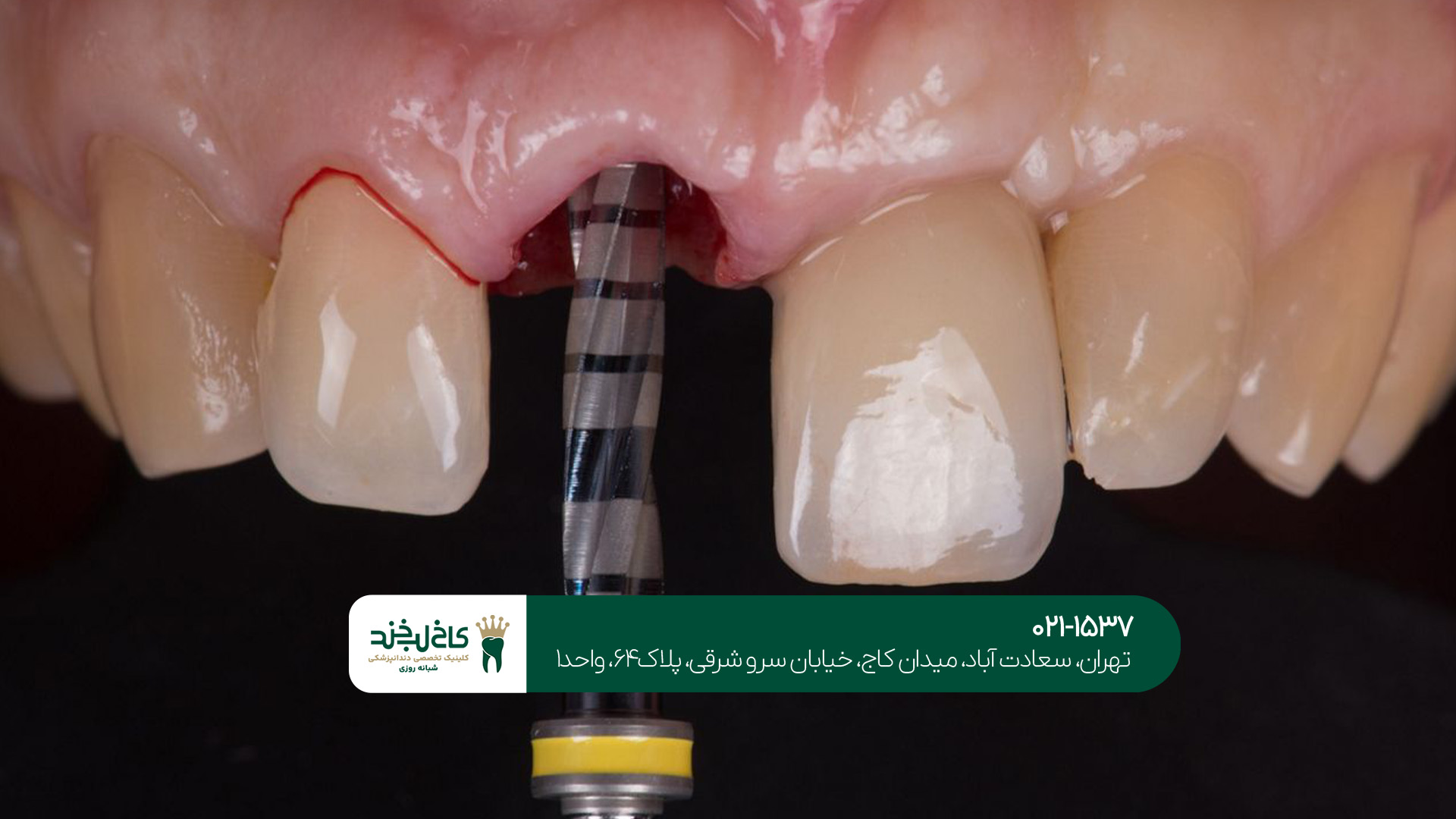 هزینه ایمپلنت دندان در تهران چقدر است؟