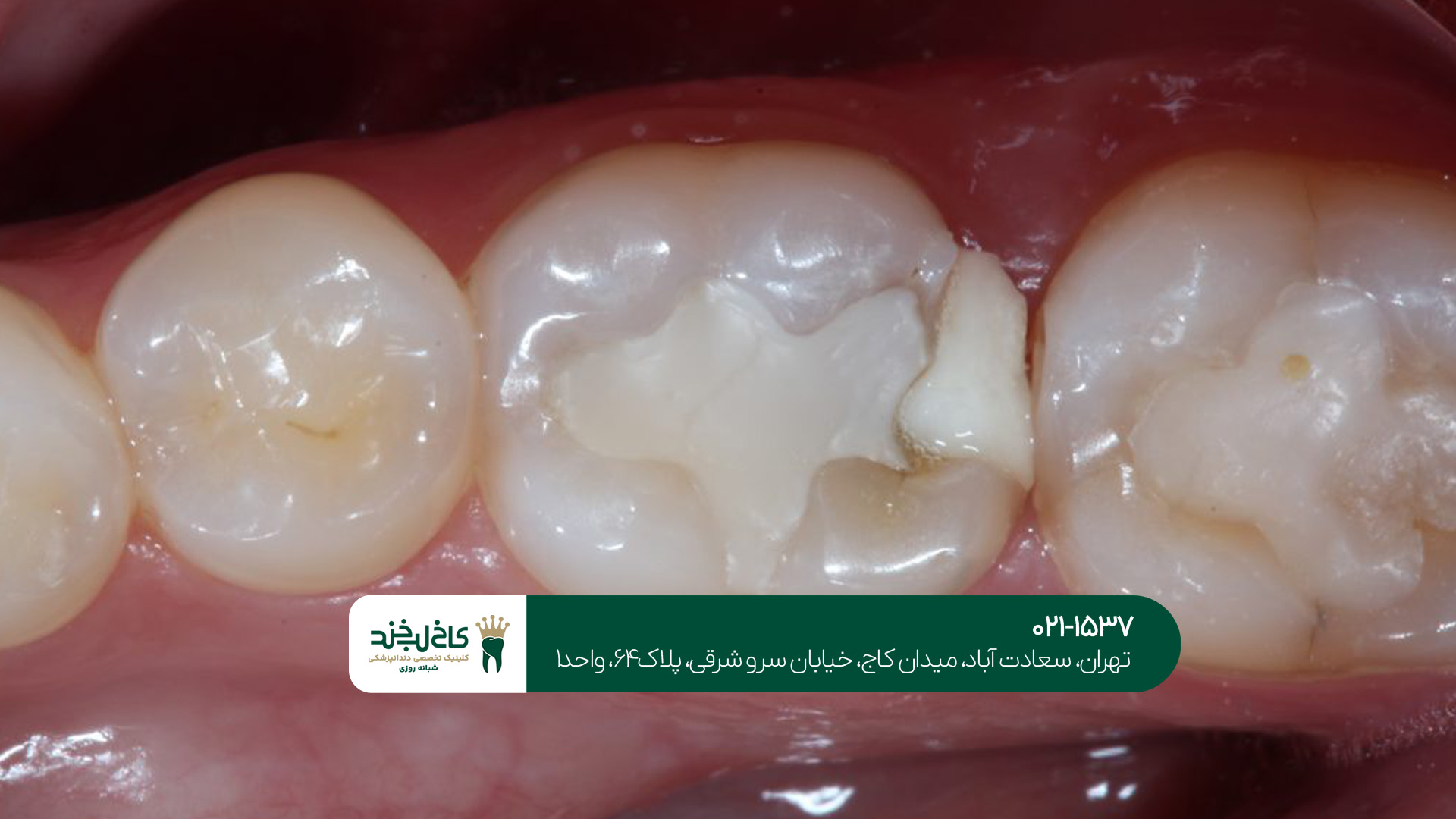 پر کردن دندان با کامپوزیت پر کردن دندان با کامپوزیت