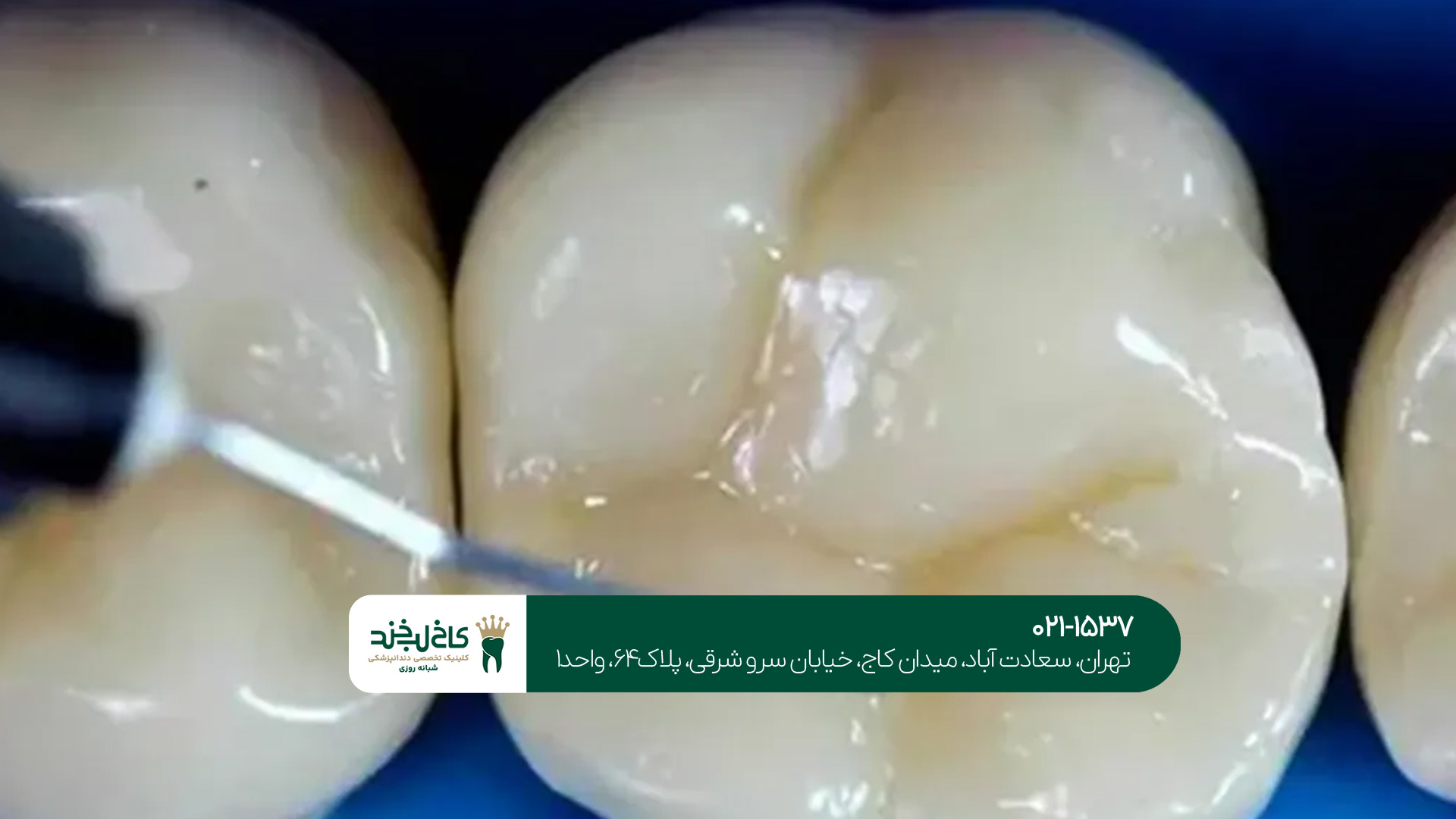 پر کردن دندان با کامپوزیت پر کردن دندان با کامپوزیت