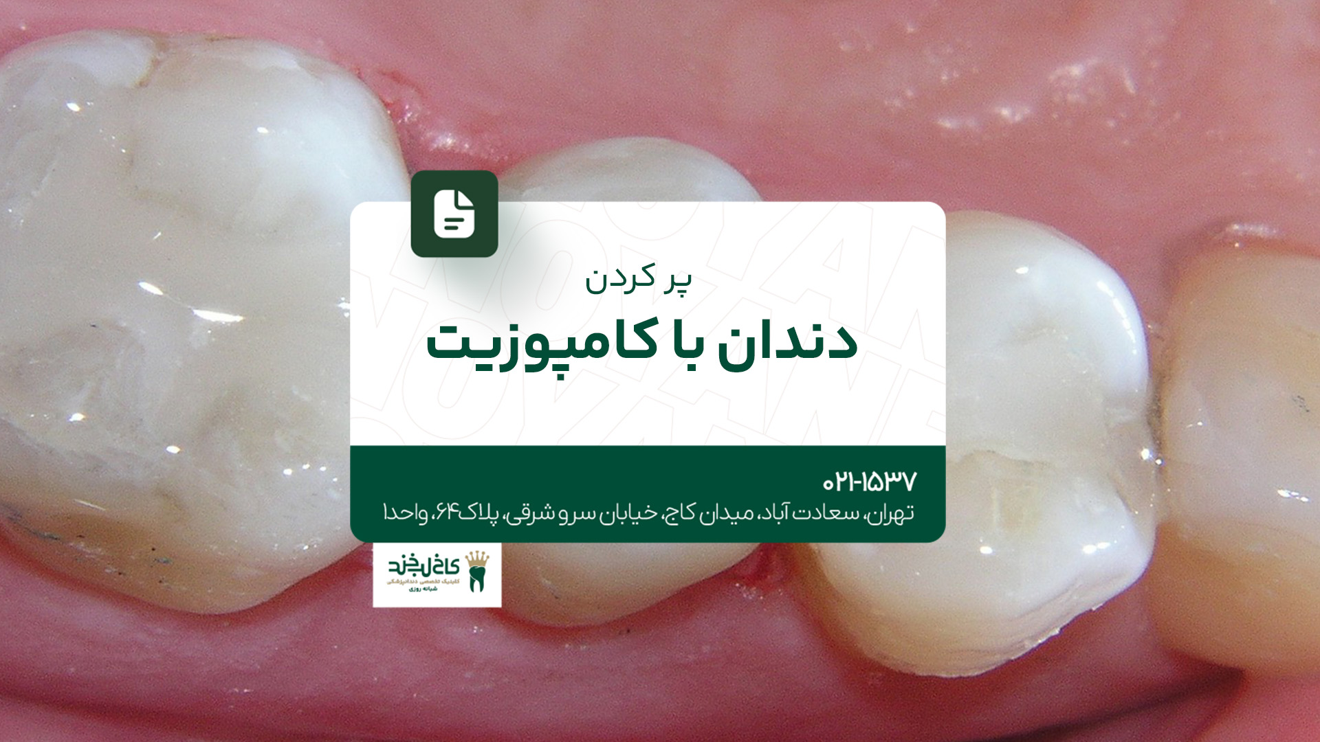 پر کردن دندان با کامپوزیت پر کردن دندان با کامپوزیت