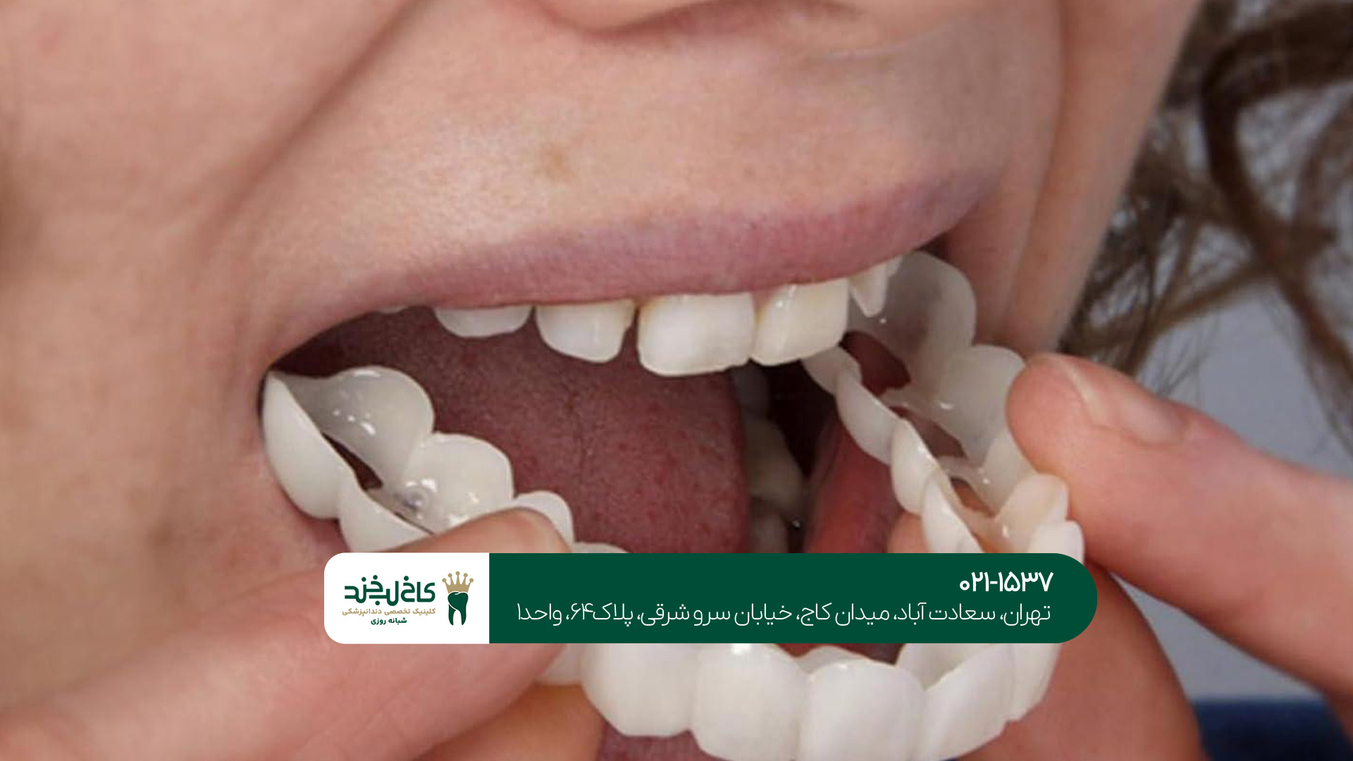 پروتز دندان چقدر عمر دارد؟ پروتز دندان چقدر عمر دارد؟