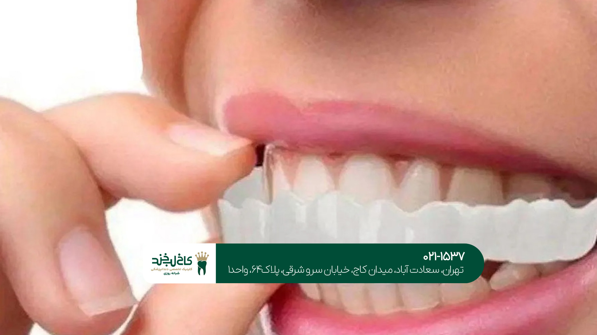 پروتز دندان چقدر عمر دارد؟ پروتز دندان چقدر عمر دارد؟