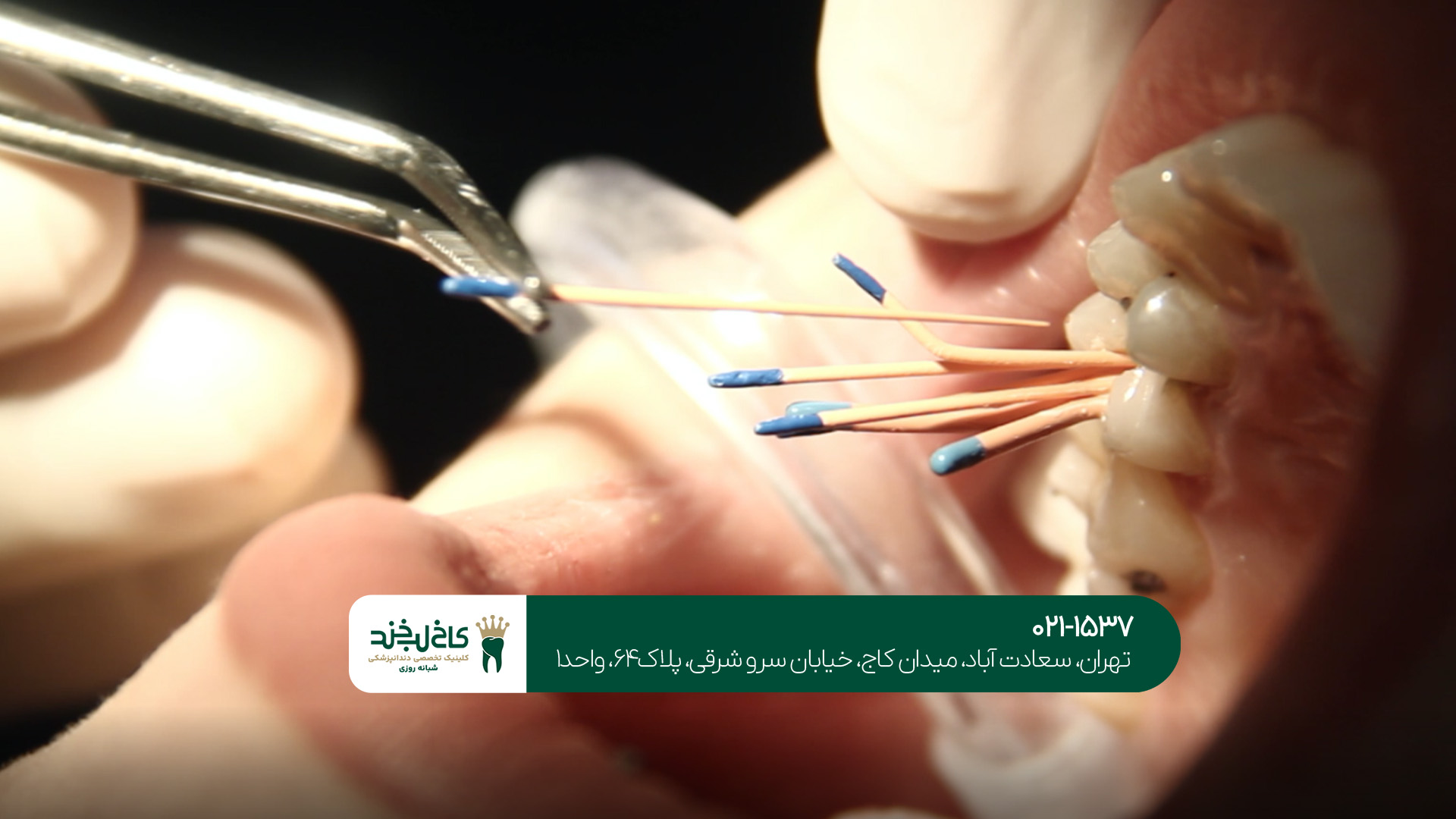 چه زمانی باید عصبکشی کنیم؟ چه زمانی باید عصبکشی کنیم؟