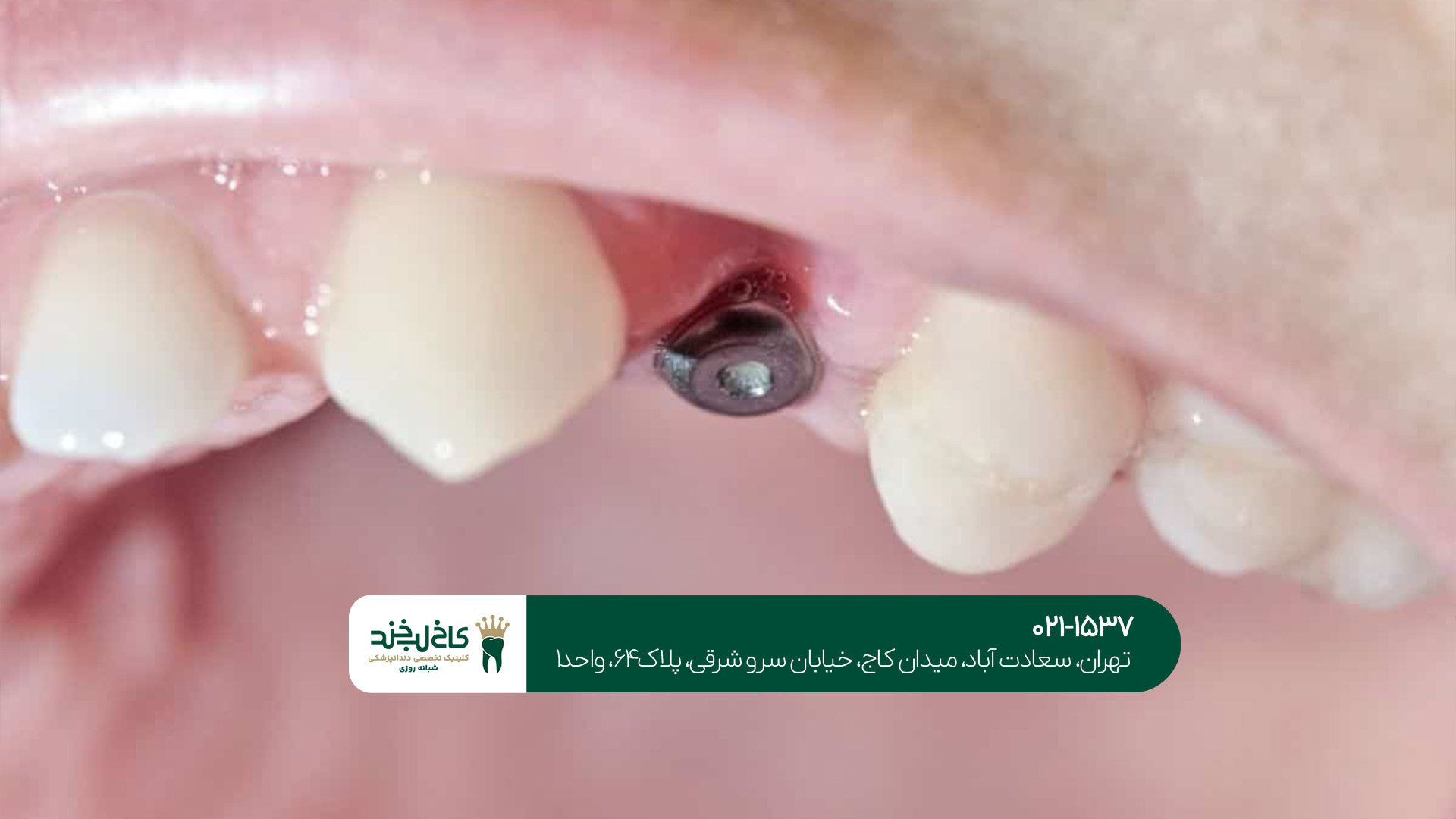 کاشت دندان به صورت نوین کاشت دندان به صورت نوین