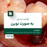 کاشت دندان به صورت نوین