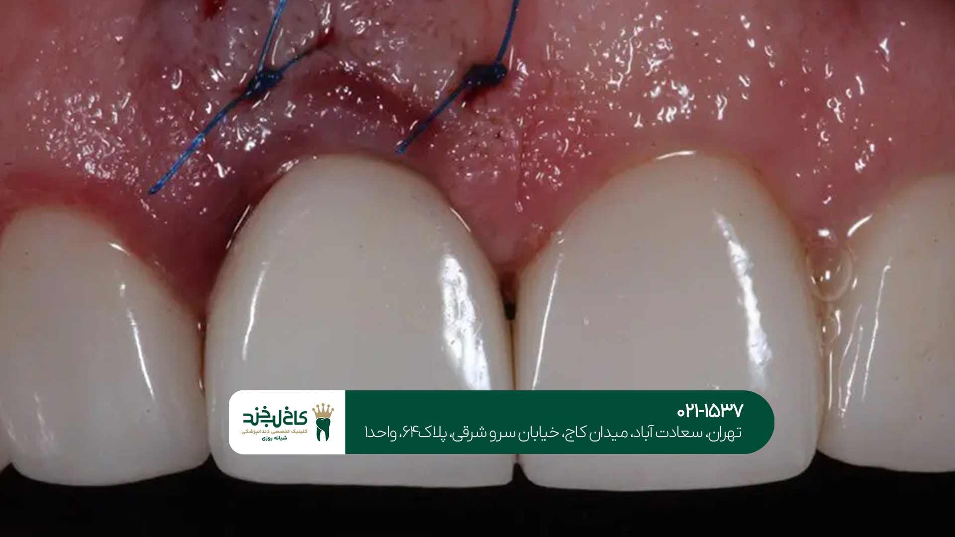 کاشت دندان به صورت نوین کاشت دندان به صورت نوین