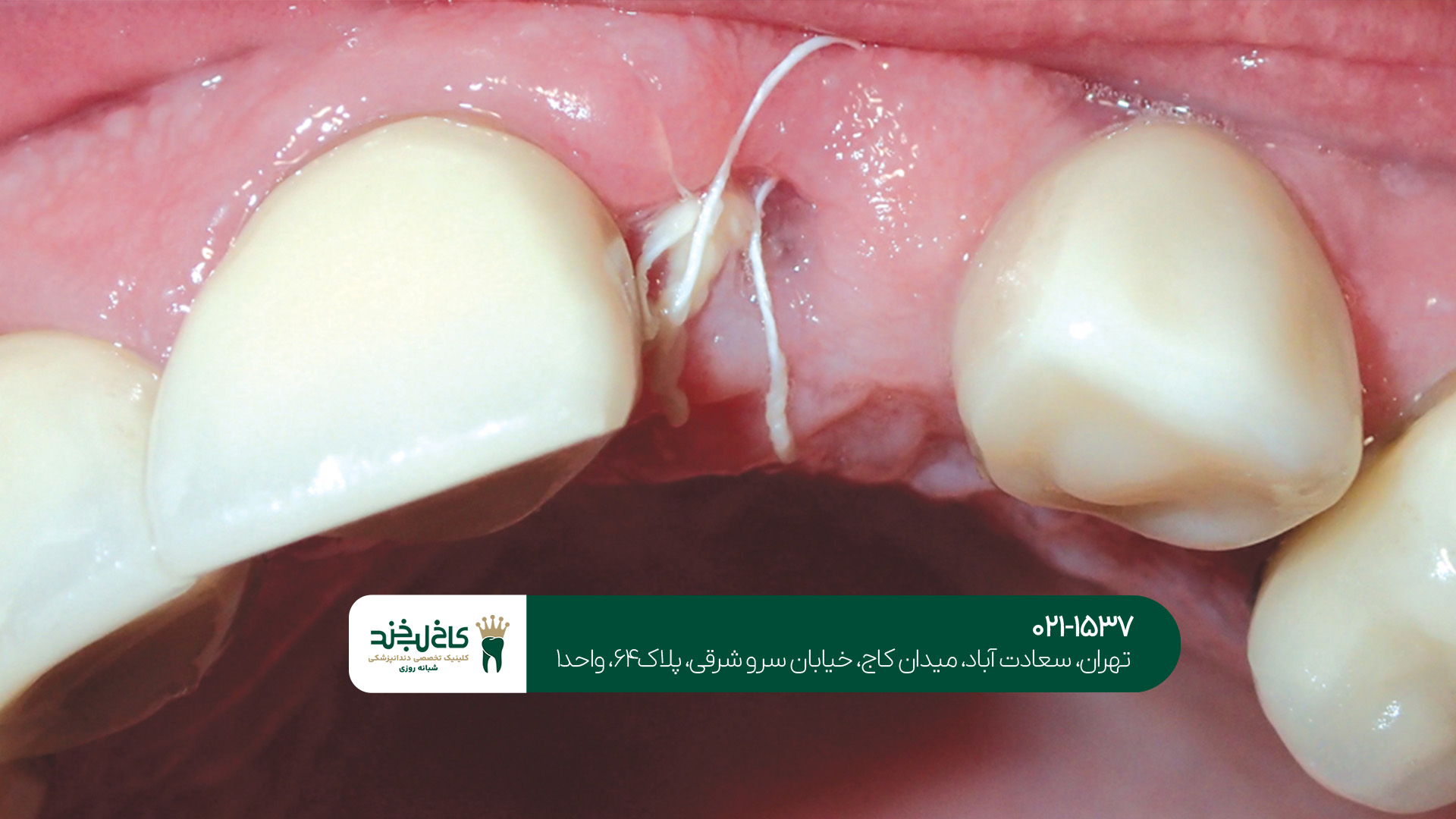 کاشت دندان به صورت نوین کاشت دندان به صورت نوین