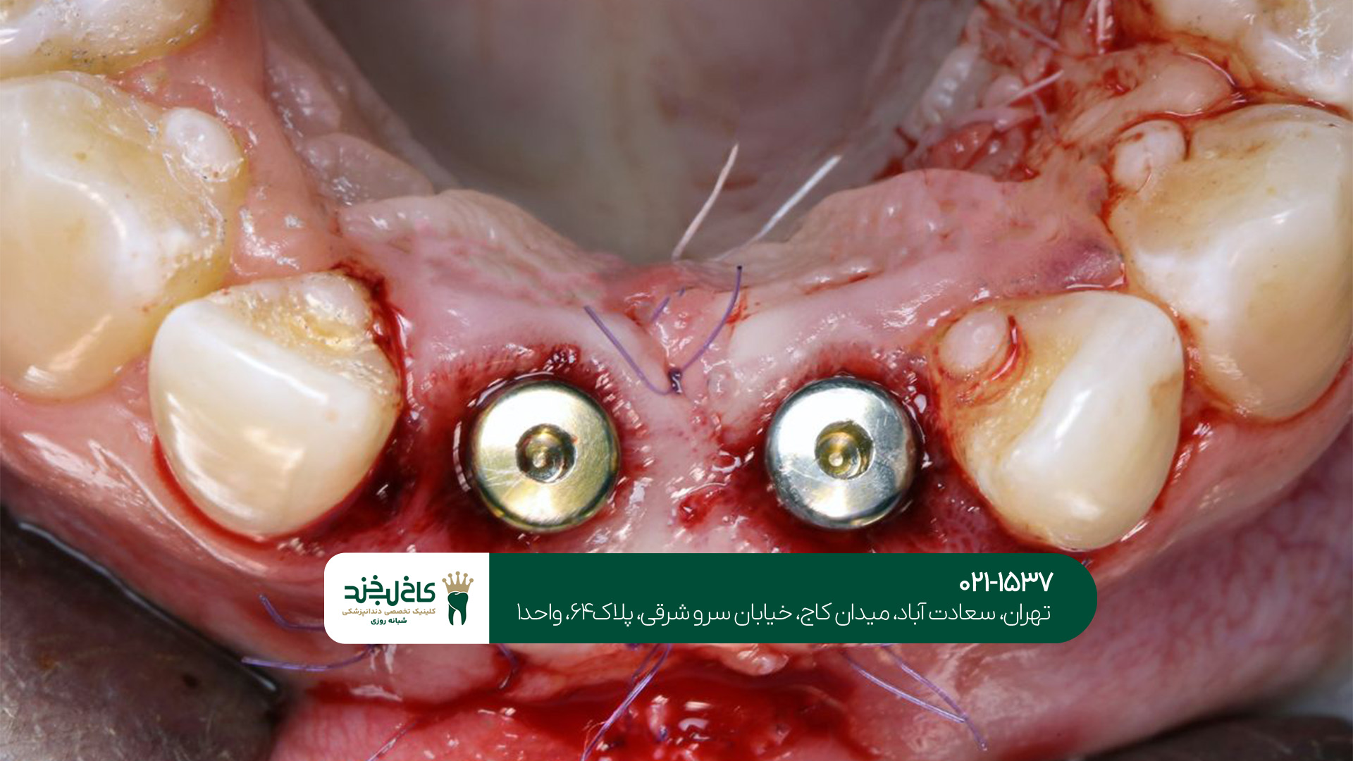 کاشت دندان در تهران