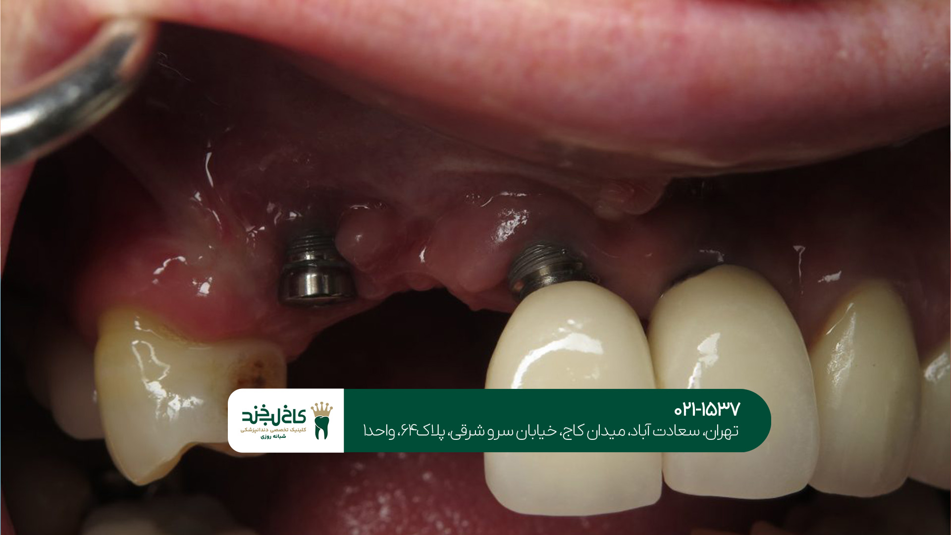 کاشت دندان در شرق تهران کاشت دندان در شرق تهران