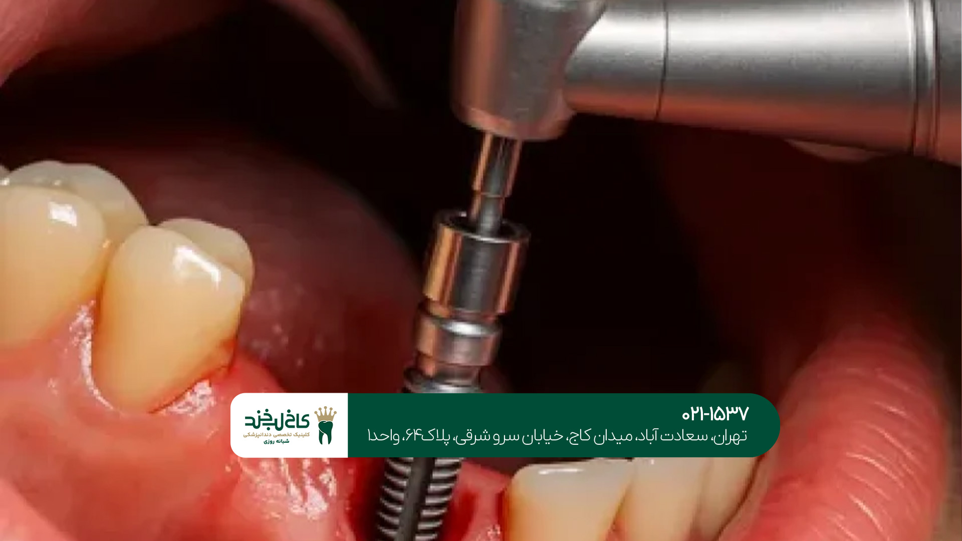ایمپلنت دندان در تهران ایمپلنت دندان در تهران