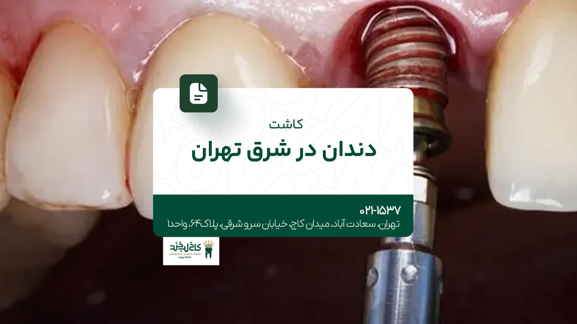 کاشت دندان در شرق تهران کاشت دندان در شرق تهران