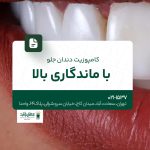 کامپوزیت دندان جلو با ماندگاری بالا