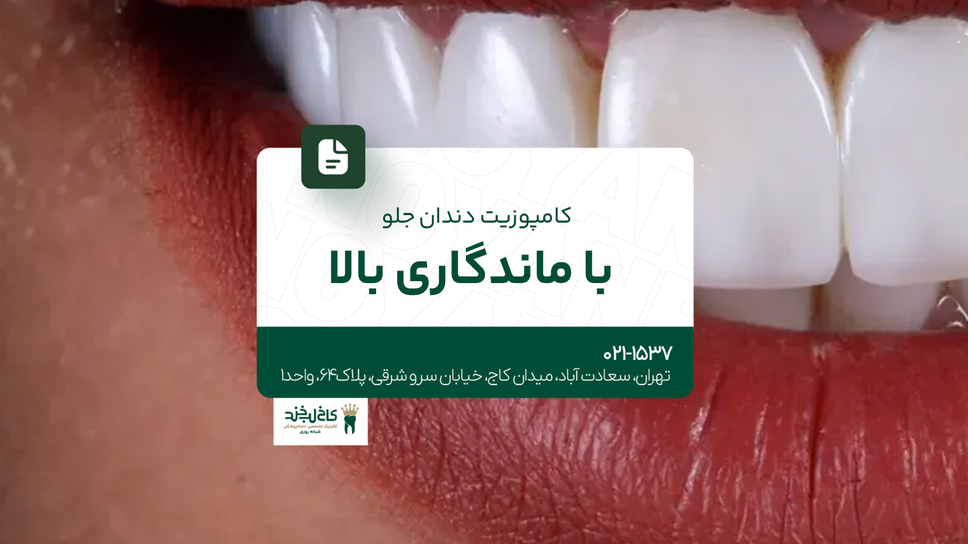 کامپوزیت دندان جلو با ماندگاری بالا