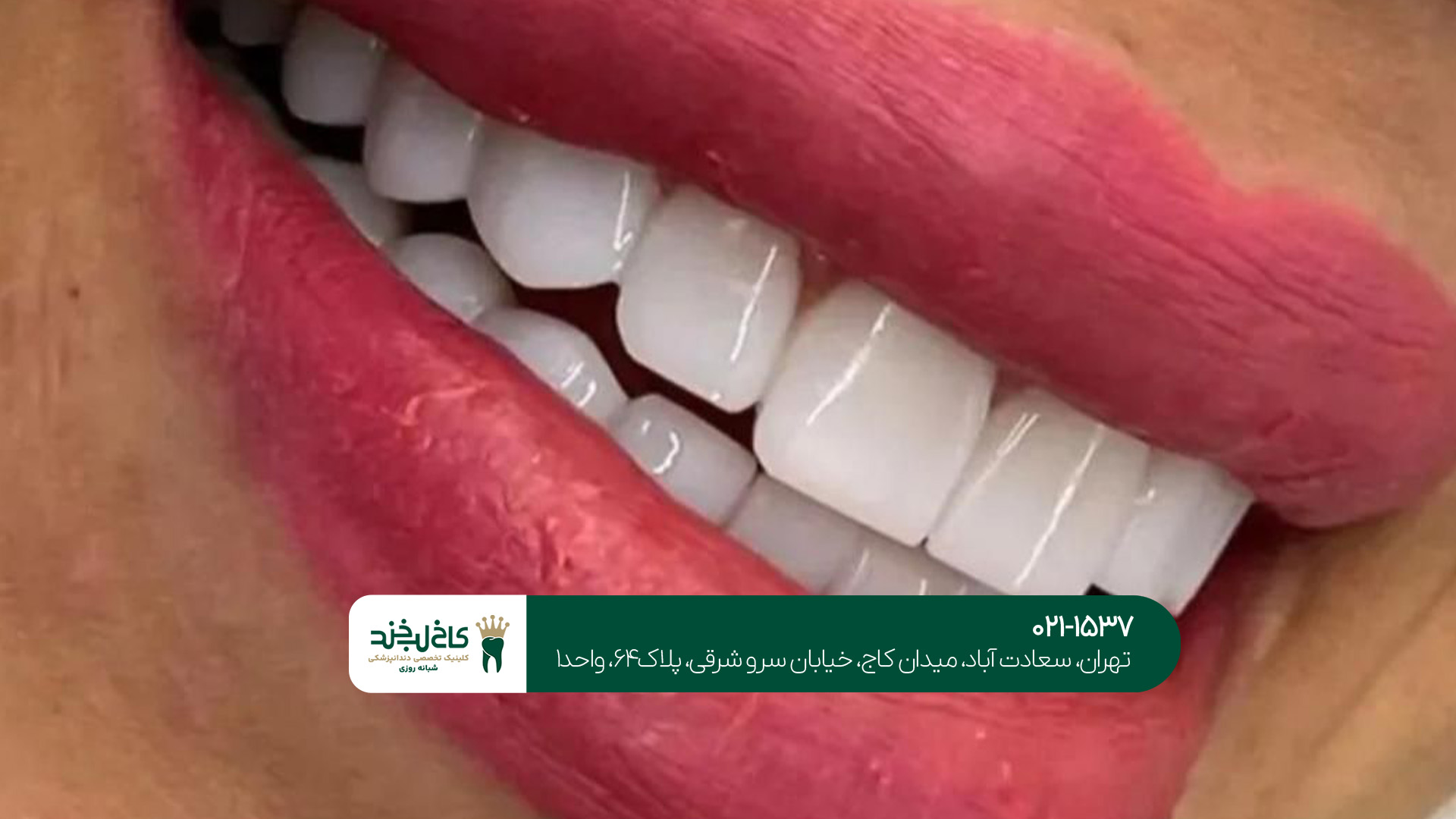 کامپوزیت دندان جلو با ماندگاری بالا