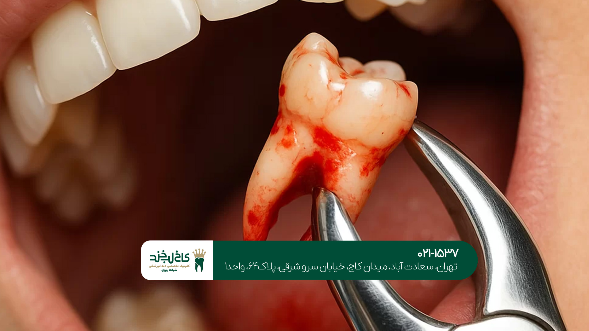 کشیدن دندان عقل در تهران کشیدن دندان عقل در تهران