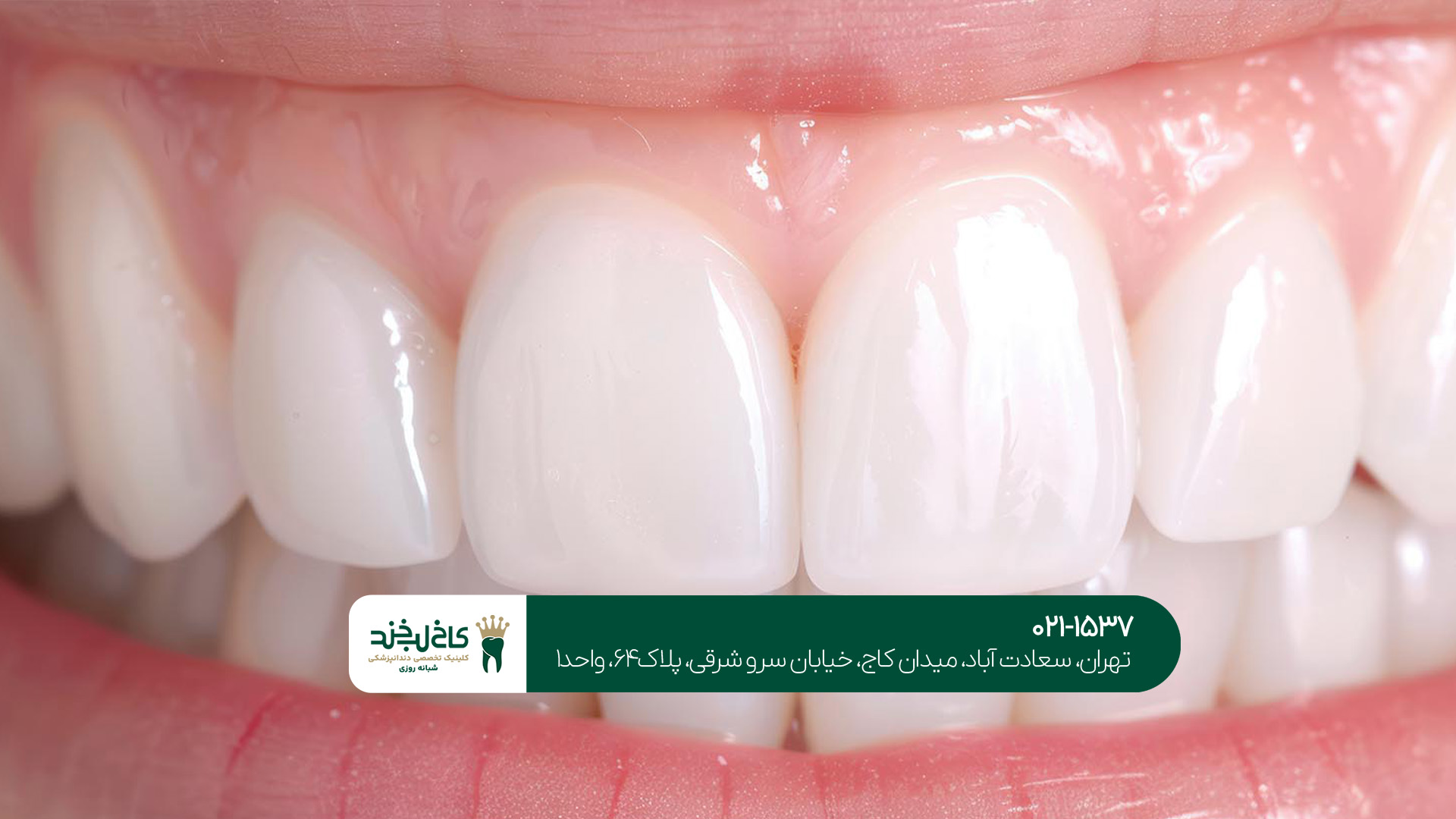 کمتهاجمیترین روش زیبایی دندان کمتهاجمیترین روش زیبایی دندان