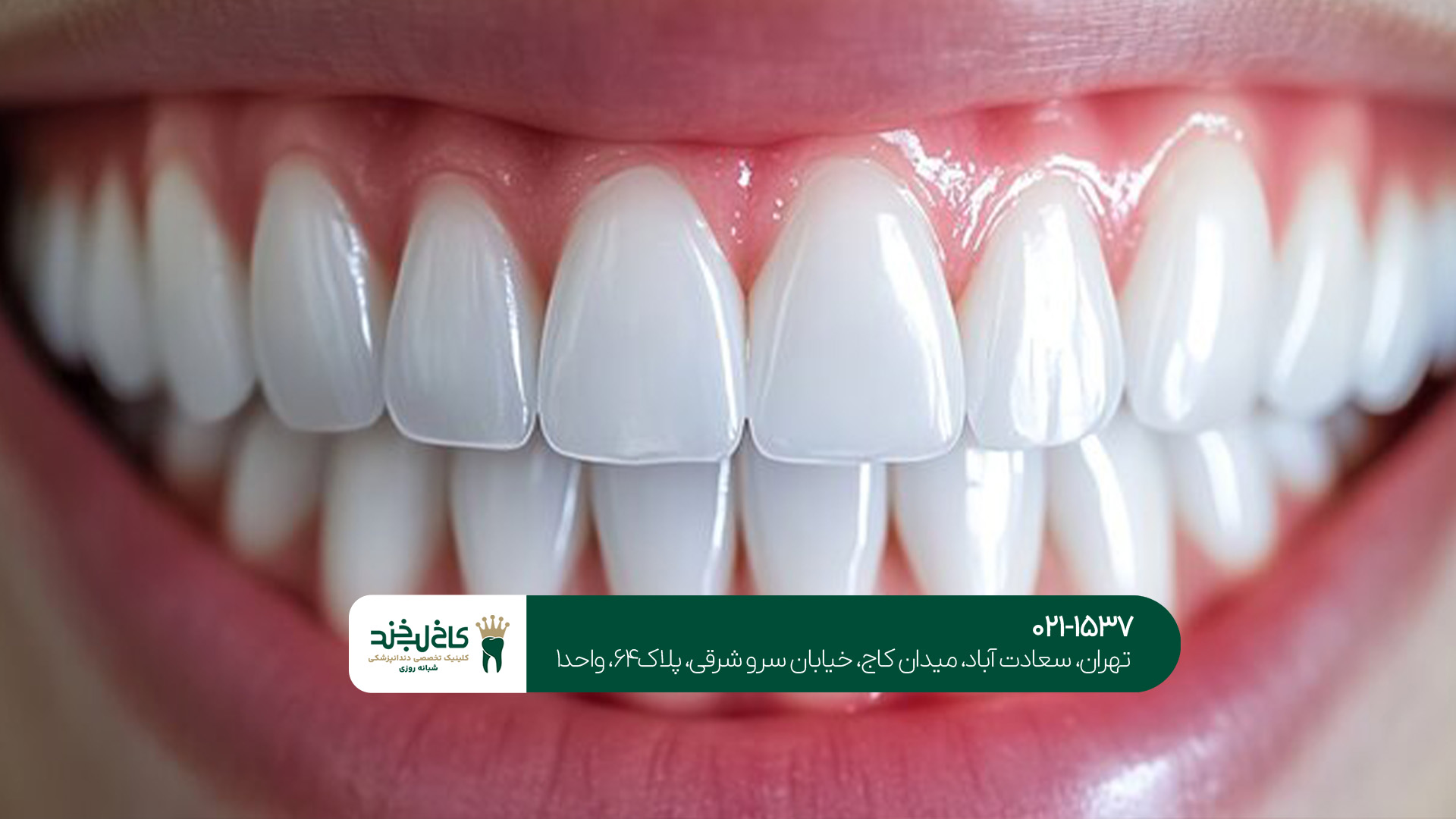 کمتهاجمیترین روش زیبایی دندان کمتهاجمیترین روش زیبایی دندان