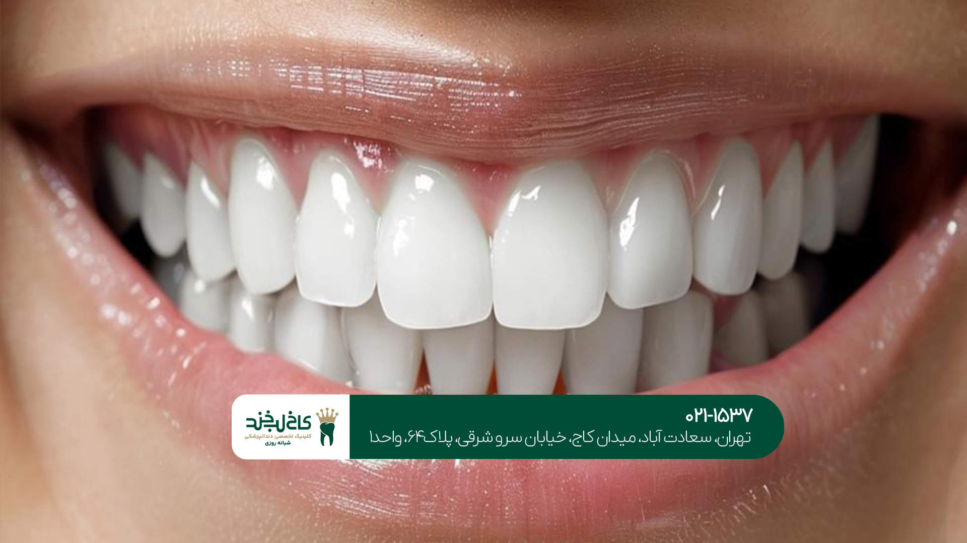 کمتهاجمیترین روش زیبایی دندان کمتهاجمیترین روش زیبایی دندان