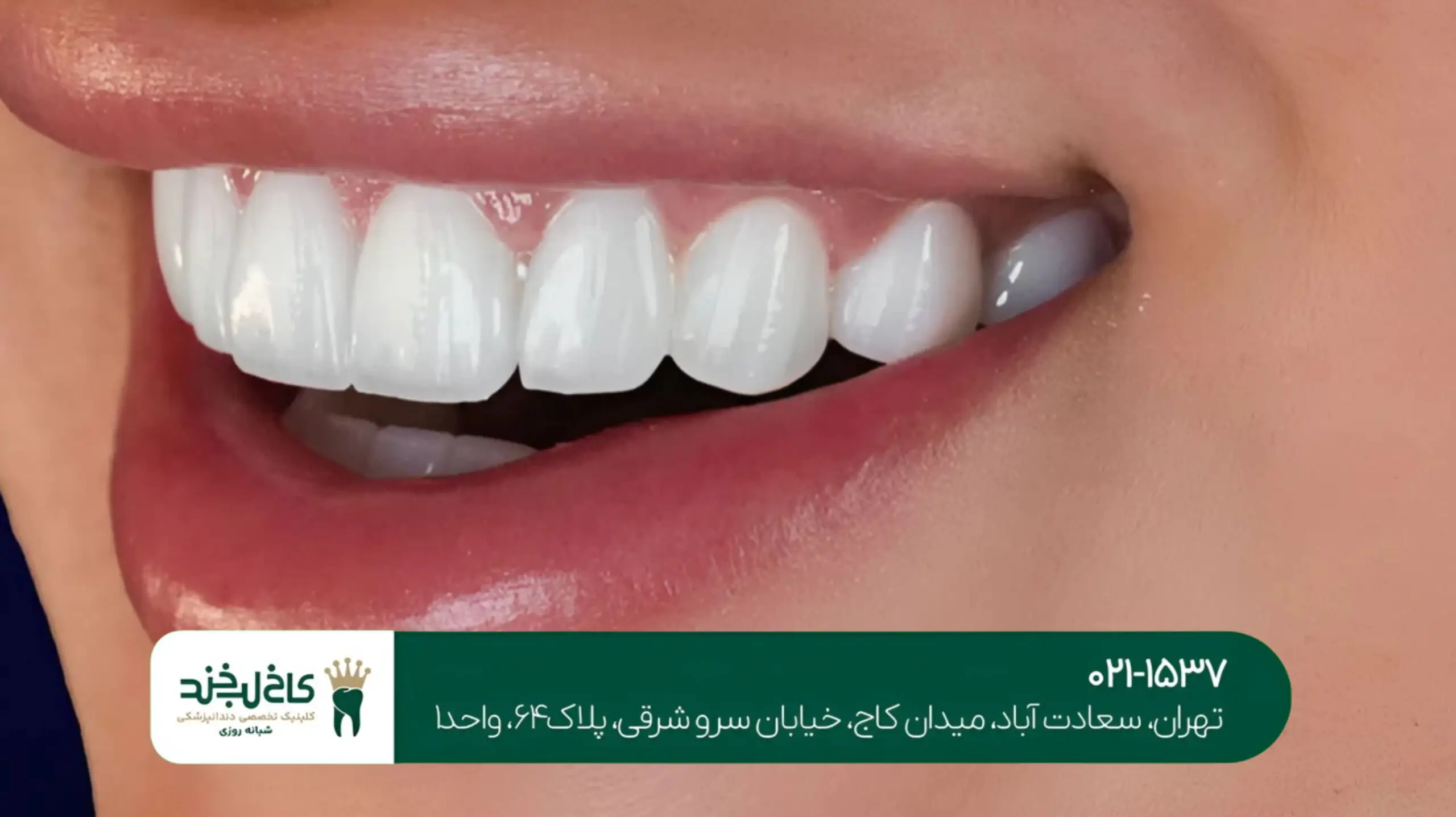 روکش دندان با متریال درجه یک