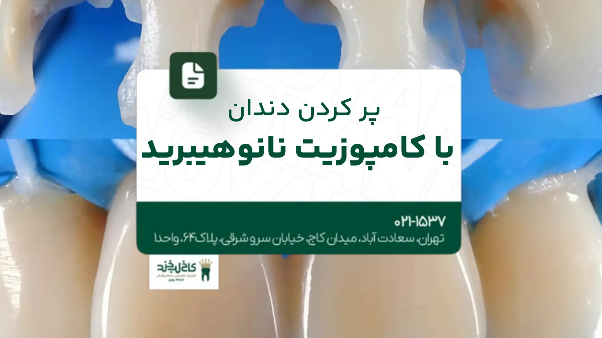 پر کردن دندان با کامپوزیت نانوهیبرید