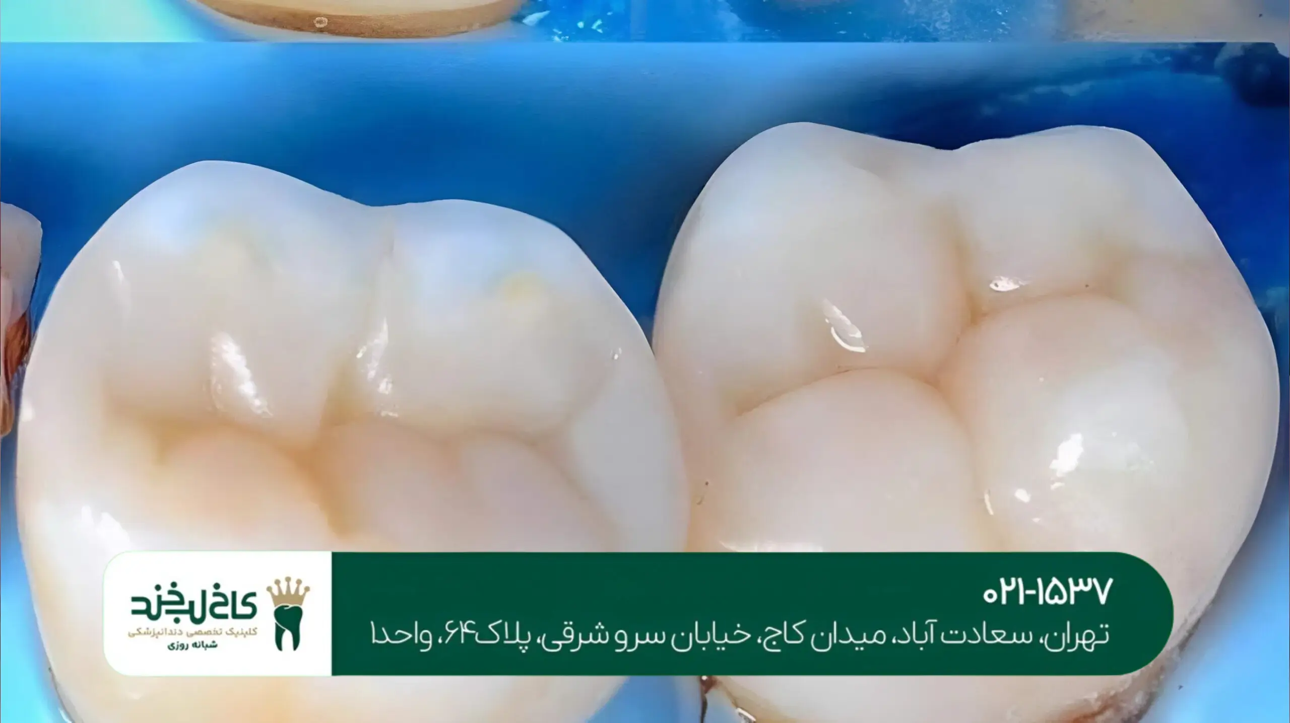 پر کردن دندان با کامپوزیت نانوهیبرید