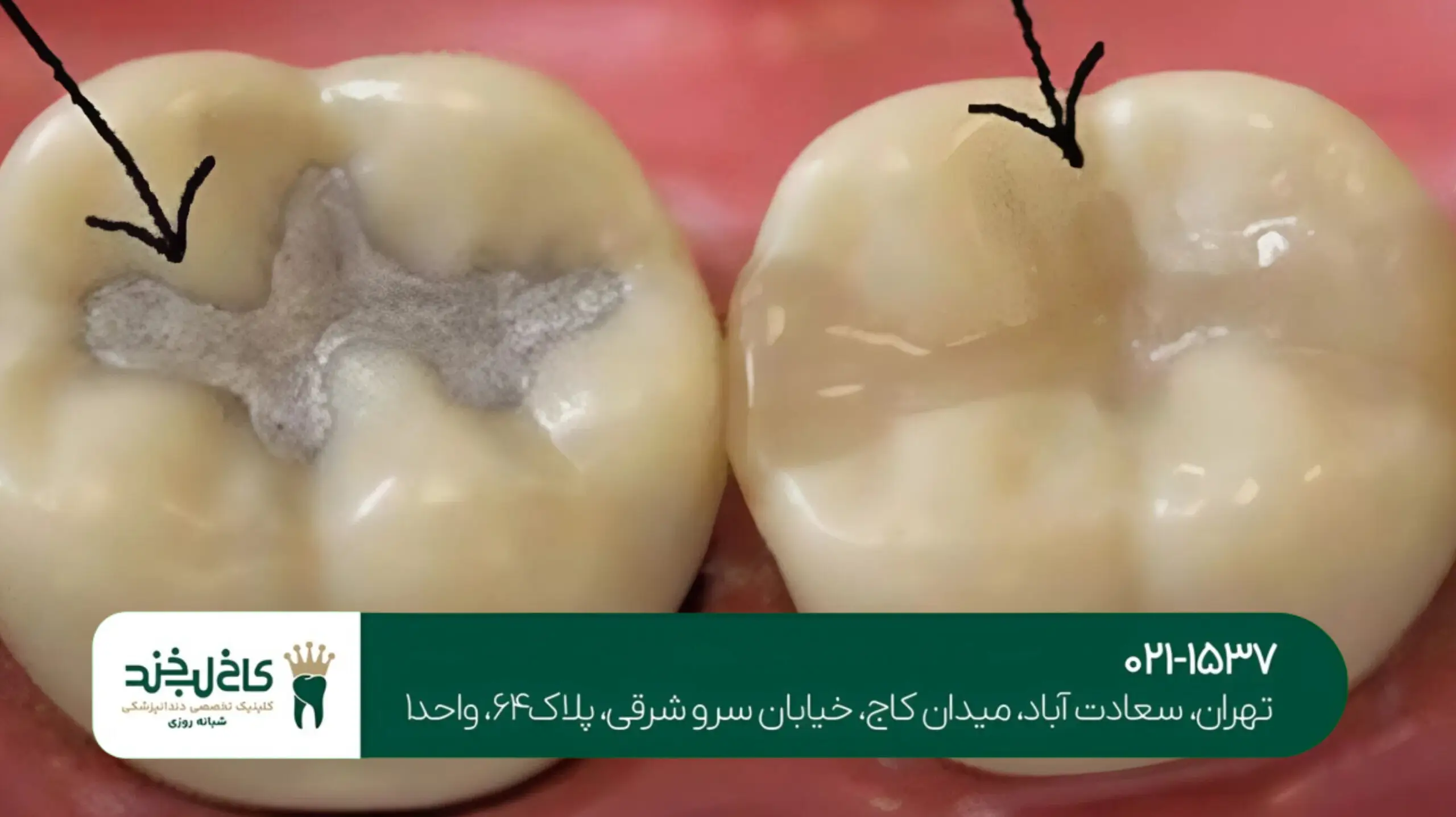 پر کردن دندان با کامپوزیت نانوهیبرید