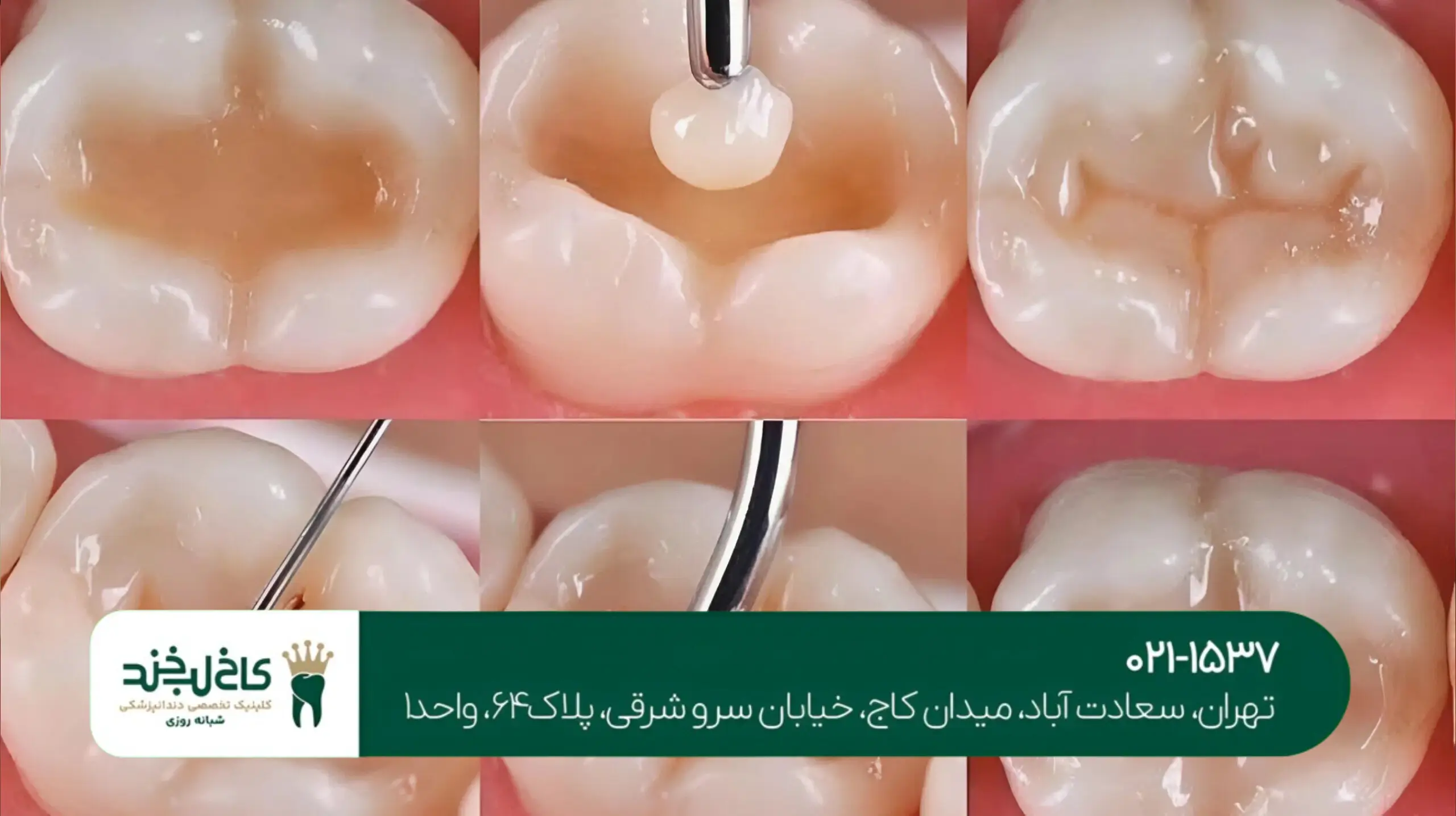 پر کردن دندان با کامپوزیت نانوهیبرید