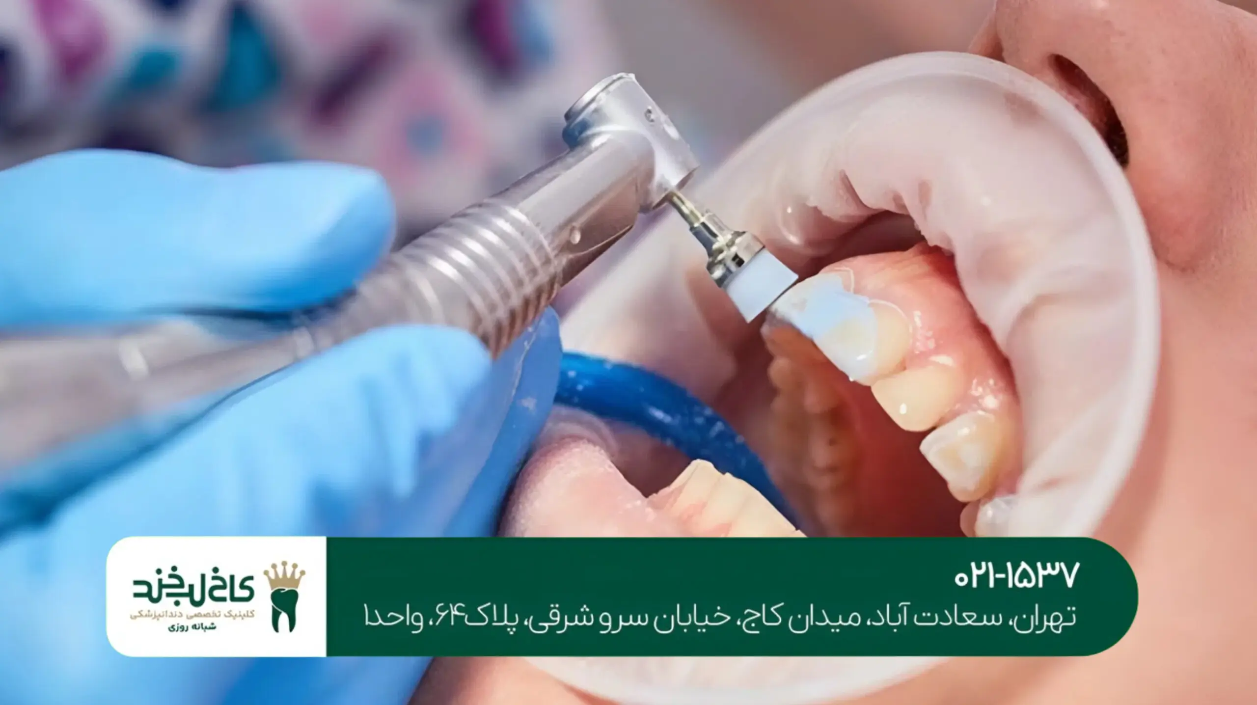 درمان پوسیدگی دندان با لیزر