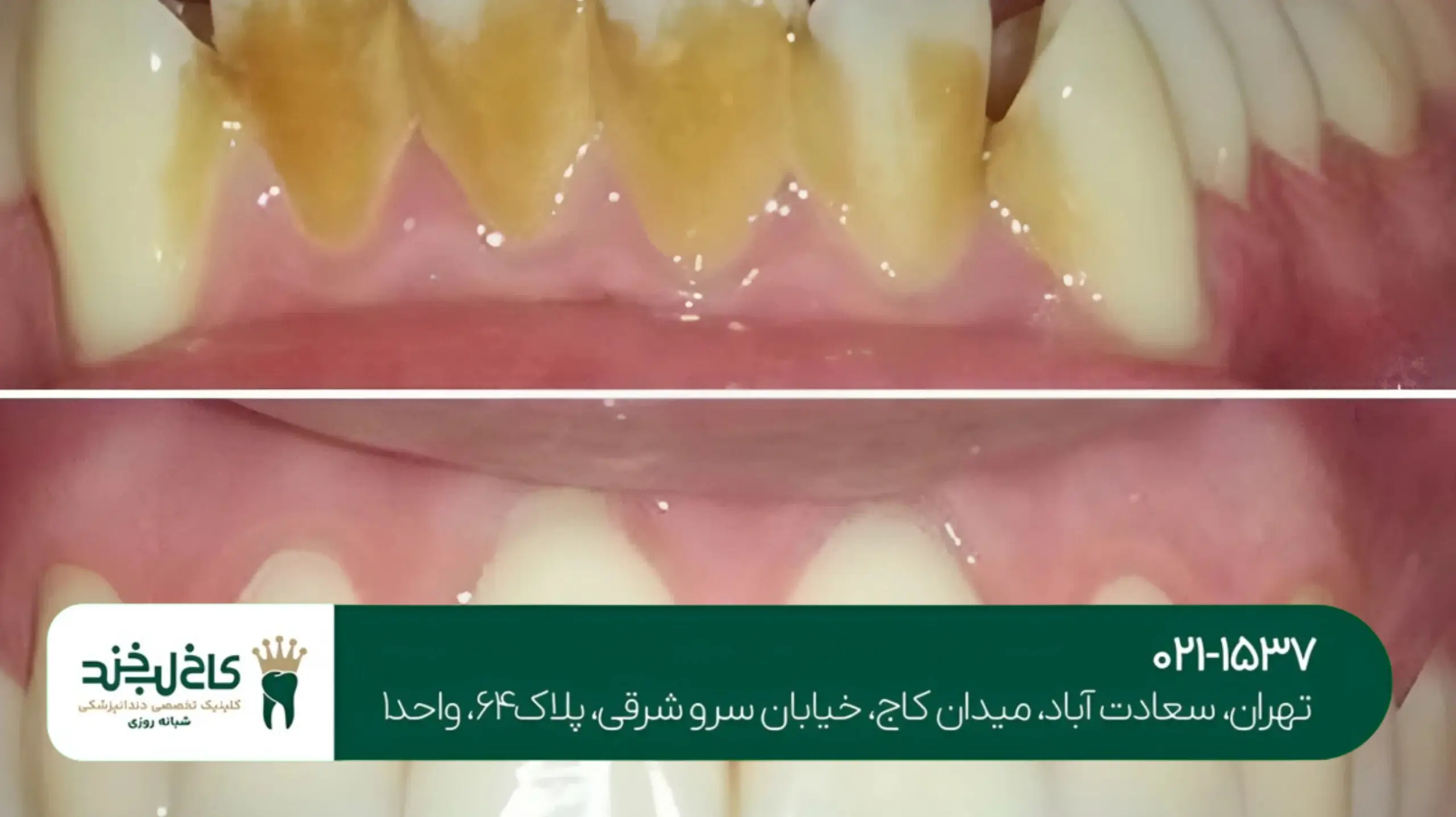 درمان پوسیدگی دندان با لیزر