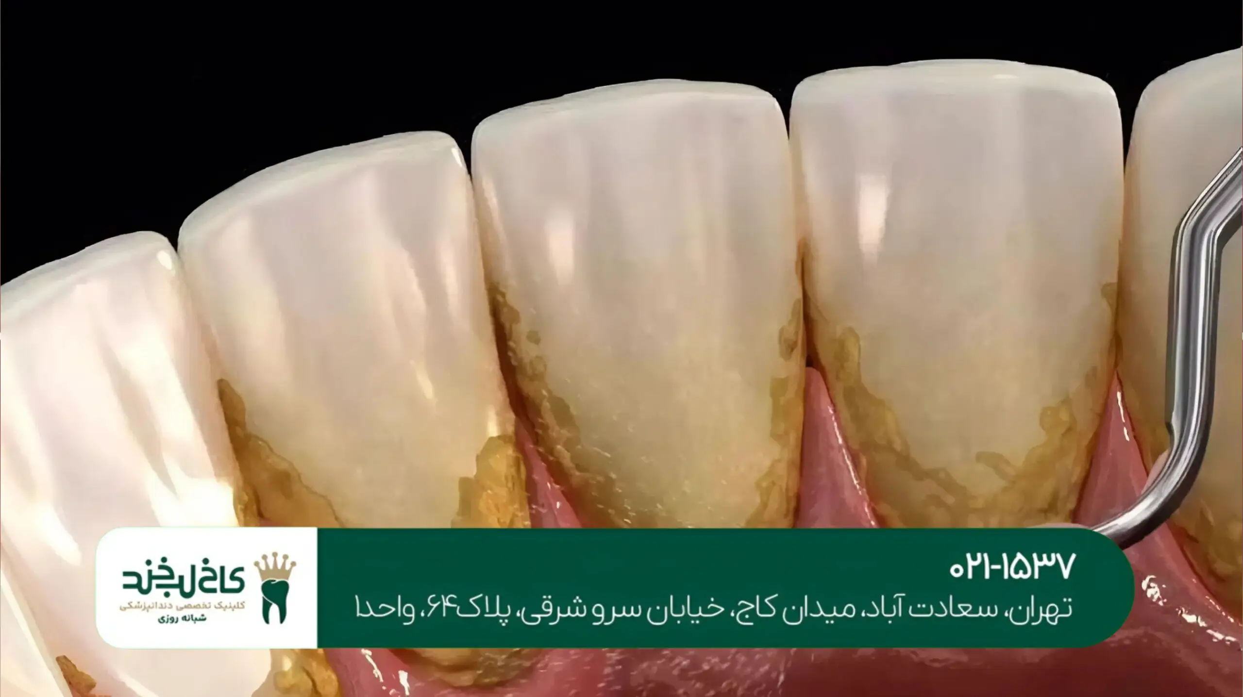 درمان پوسیدگی دندان با لیزر