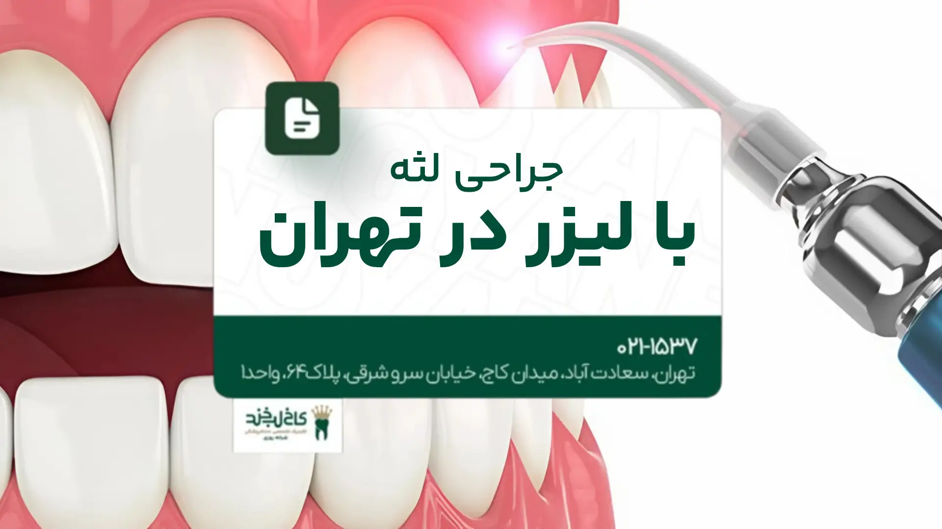 جراحی لثه با لیزر در تهران