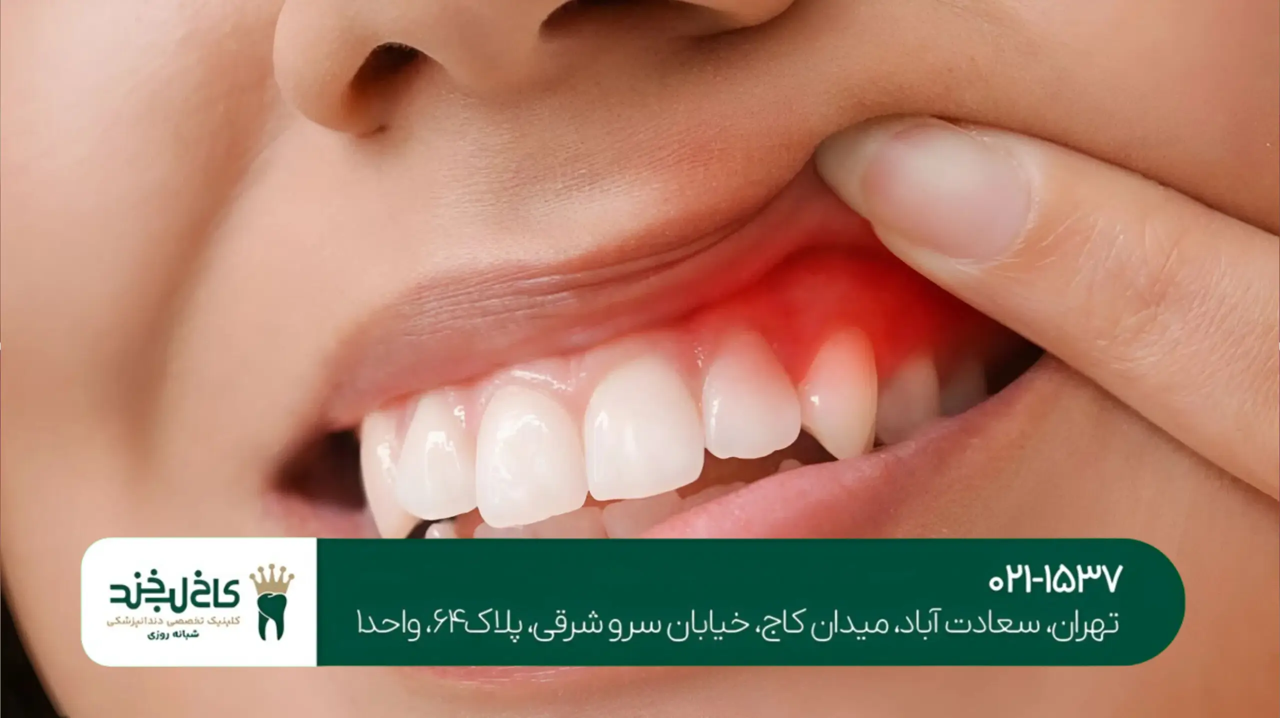 جراحی لثه با لیزر در تهران