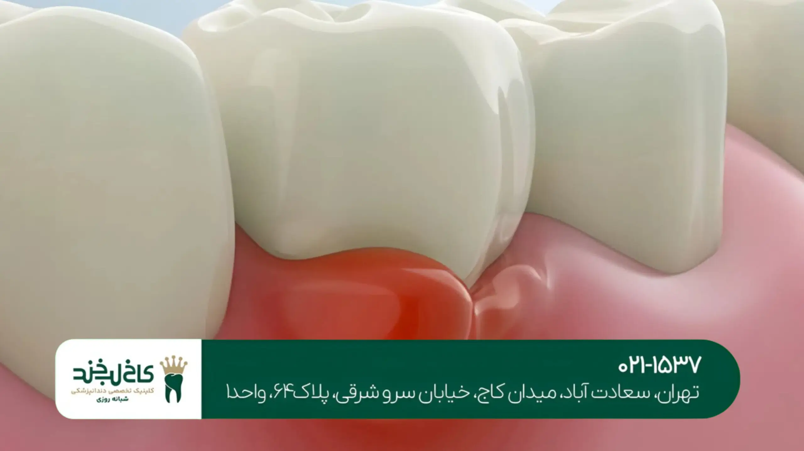 جراحی لثه با لیزر در تهران