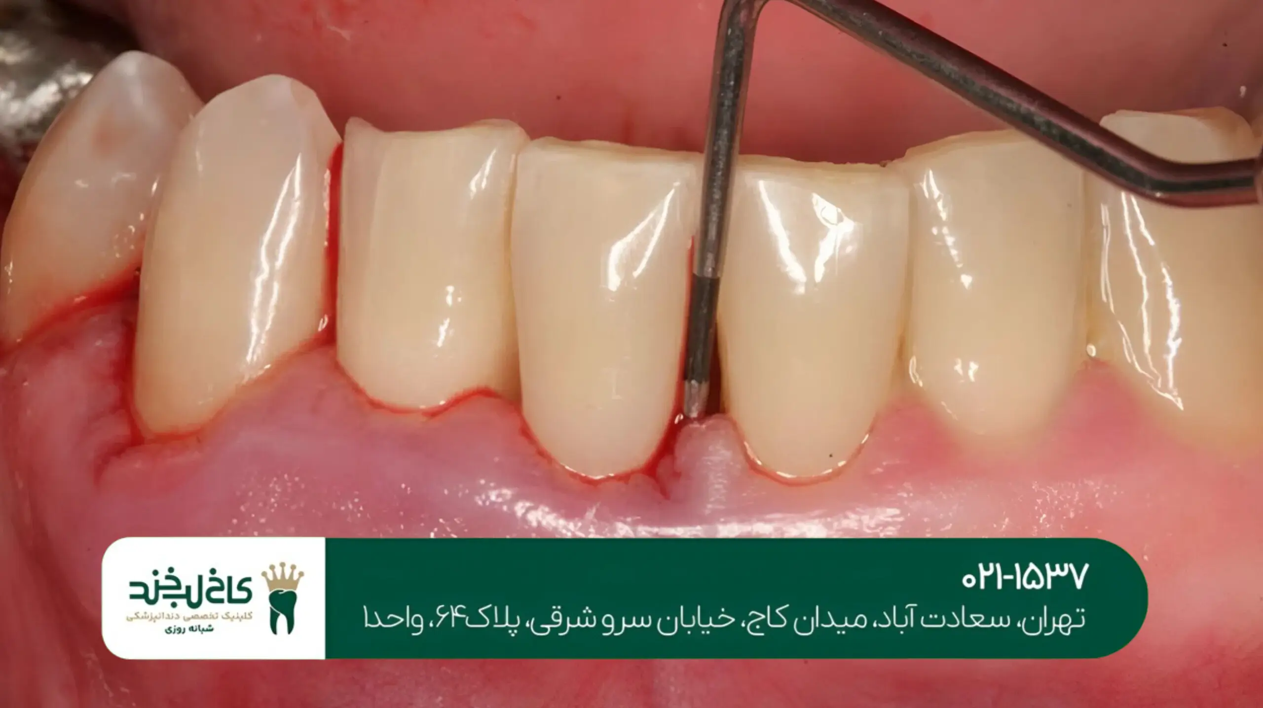 جراحی لثه با لیزر در تهران