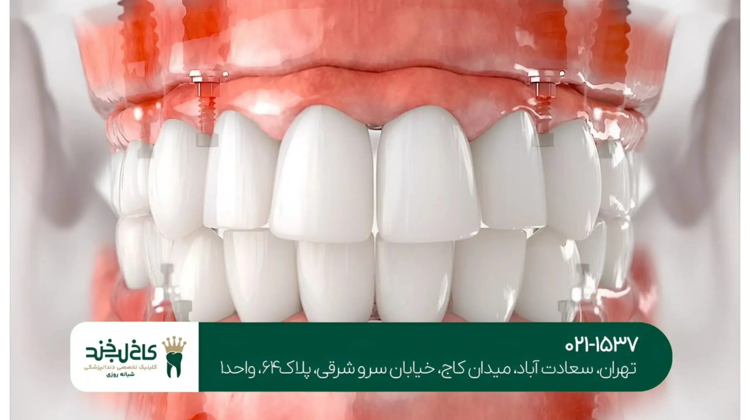 ایمپلنت دندان جلو بدون جراحی