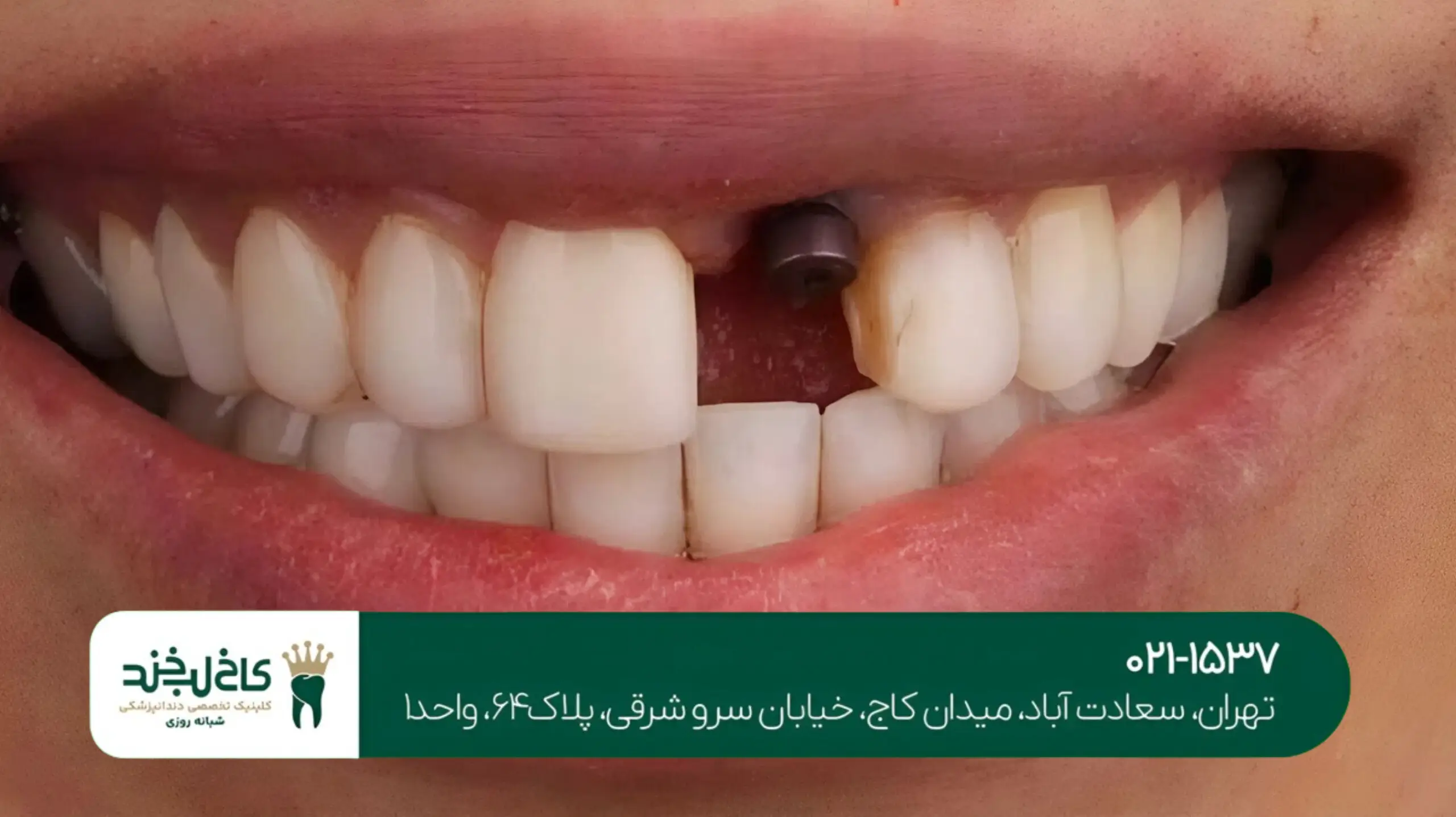 ایمپلنت دندان جلو بدون جراحی