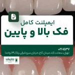 ایمپلنت کامل فک بالا و پایین