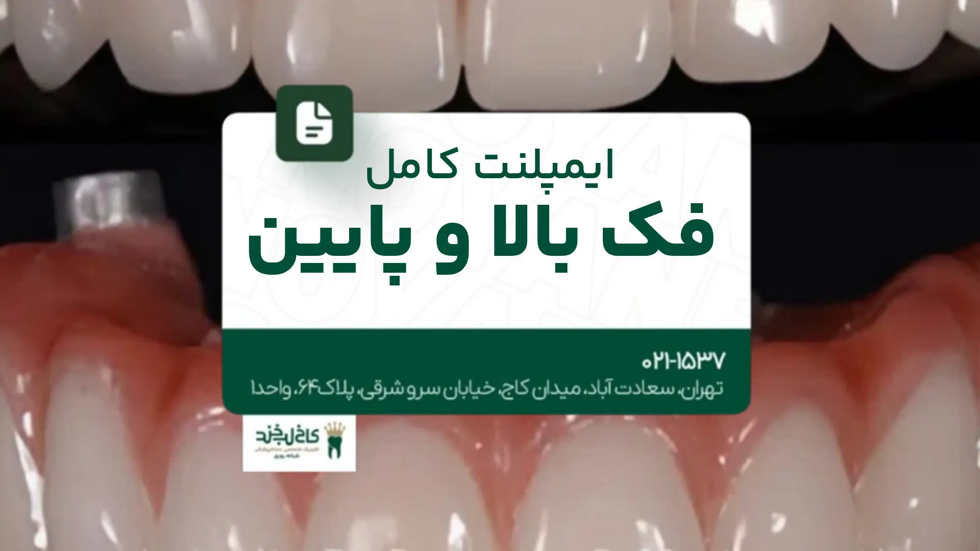 ایمپلنت کامل فک بالا و پایین