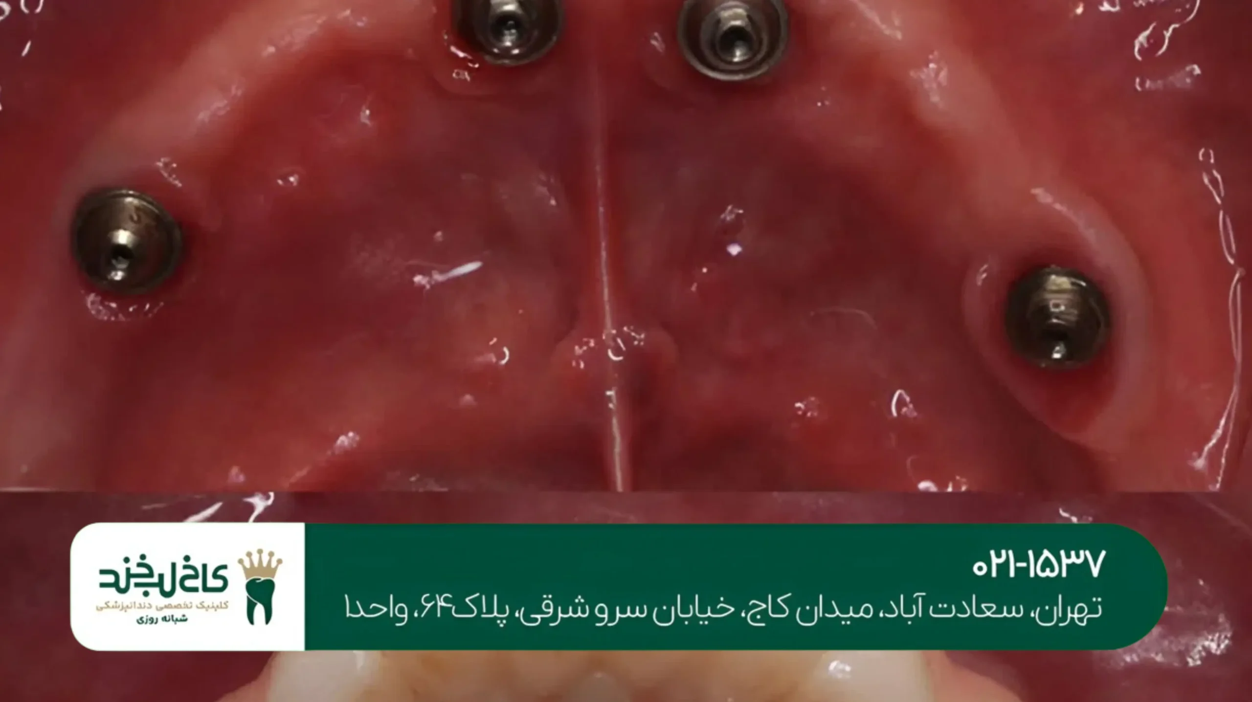 ترمیم دندان شکسته با لمینت