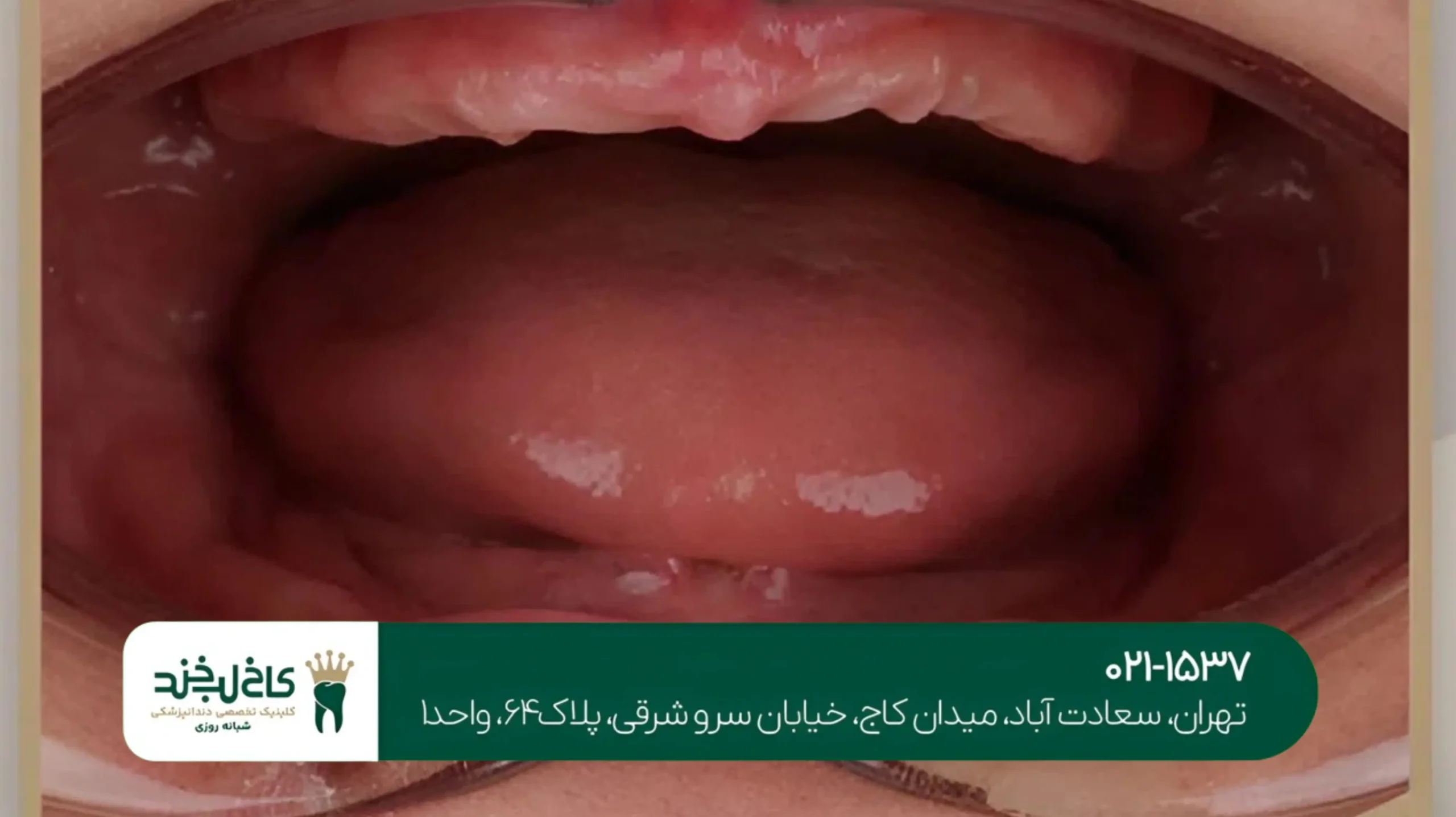 ترمیم دندان شکسته با لمینت