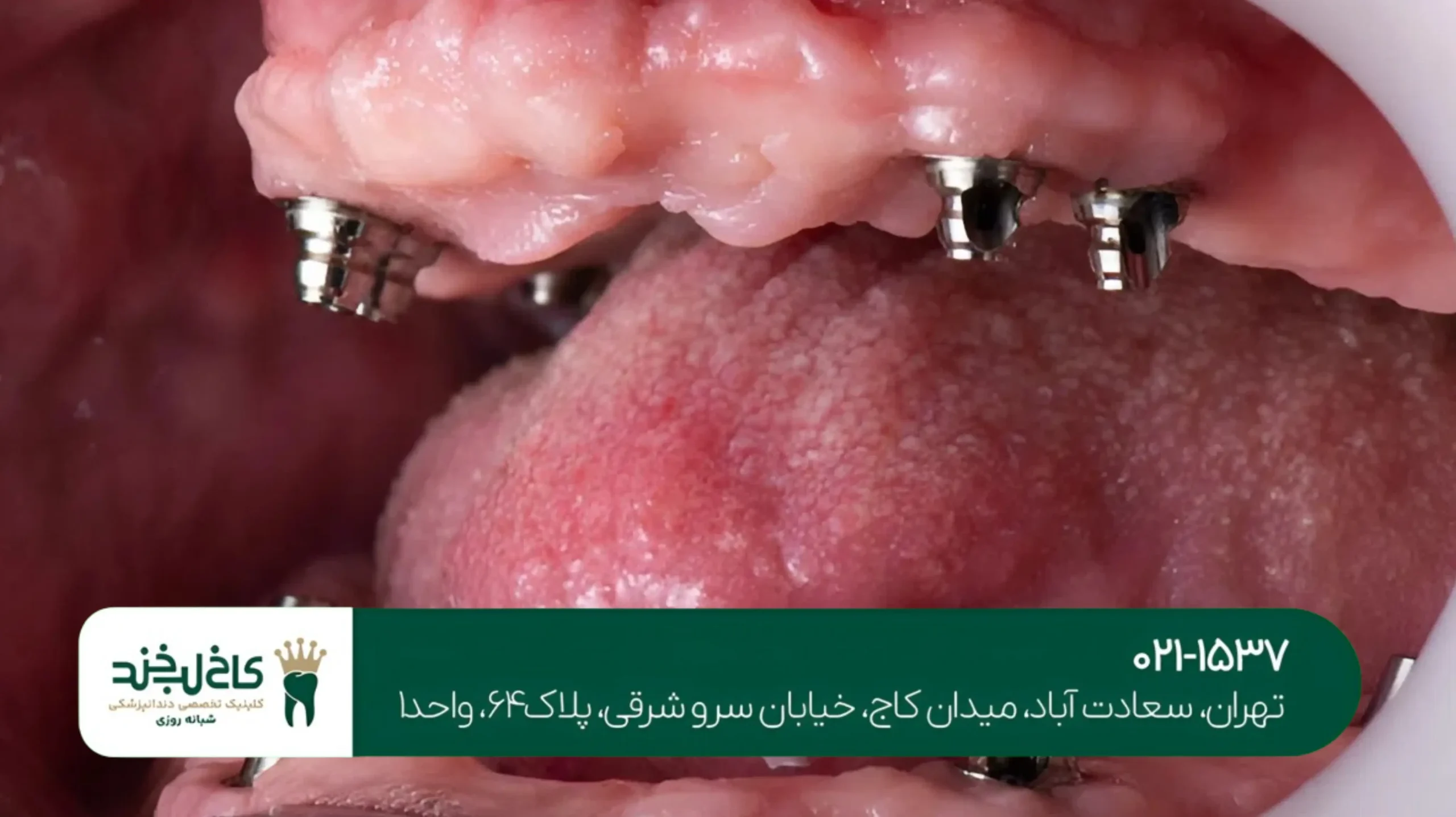 ترمیم دندان شکسته با لمینت