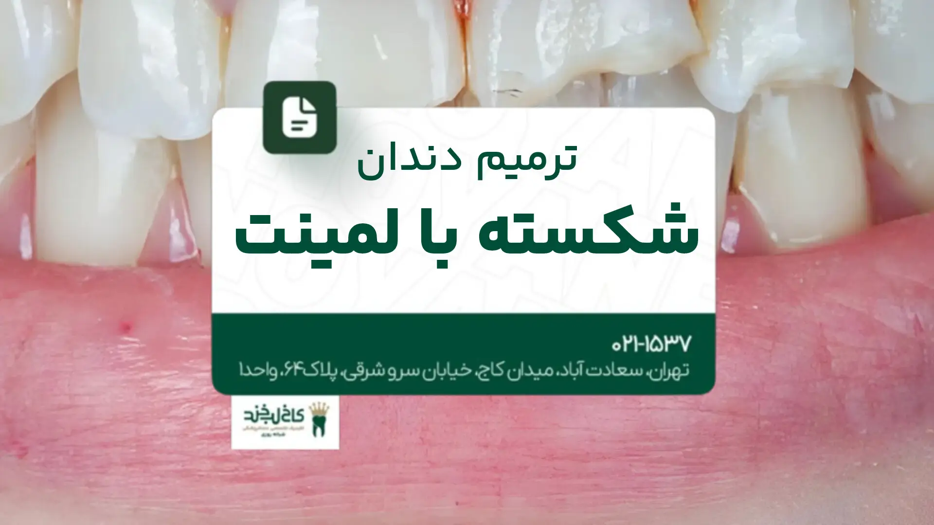 ترمیم دندان شکسته با لمینت