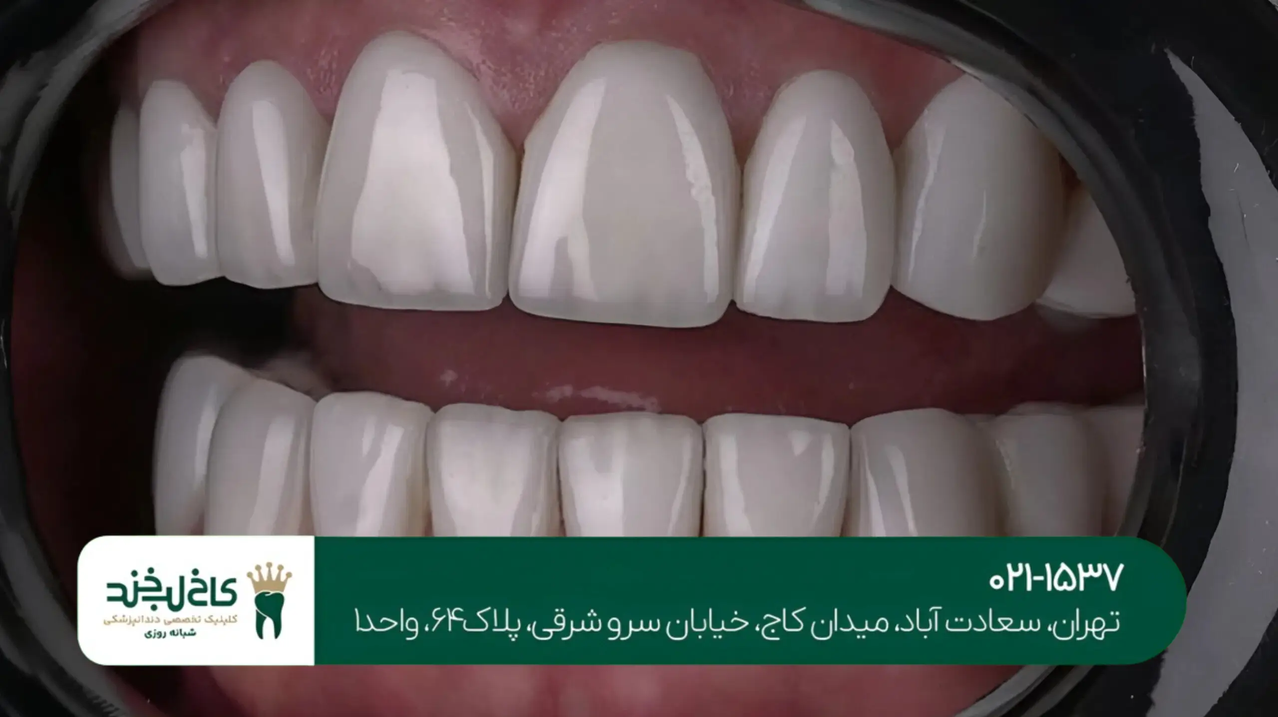 بهترین دندانپزشک لمینت در تهران