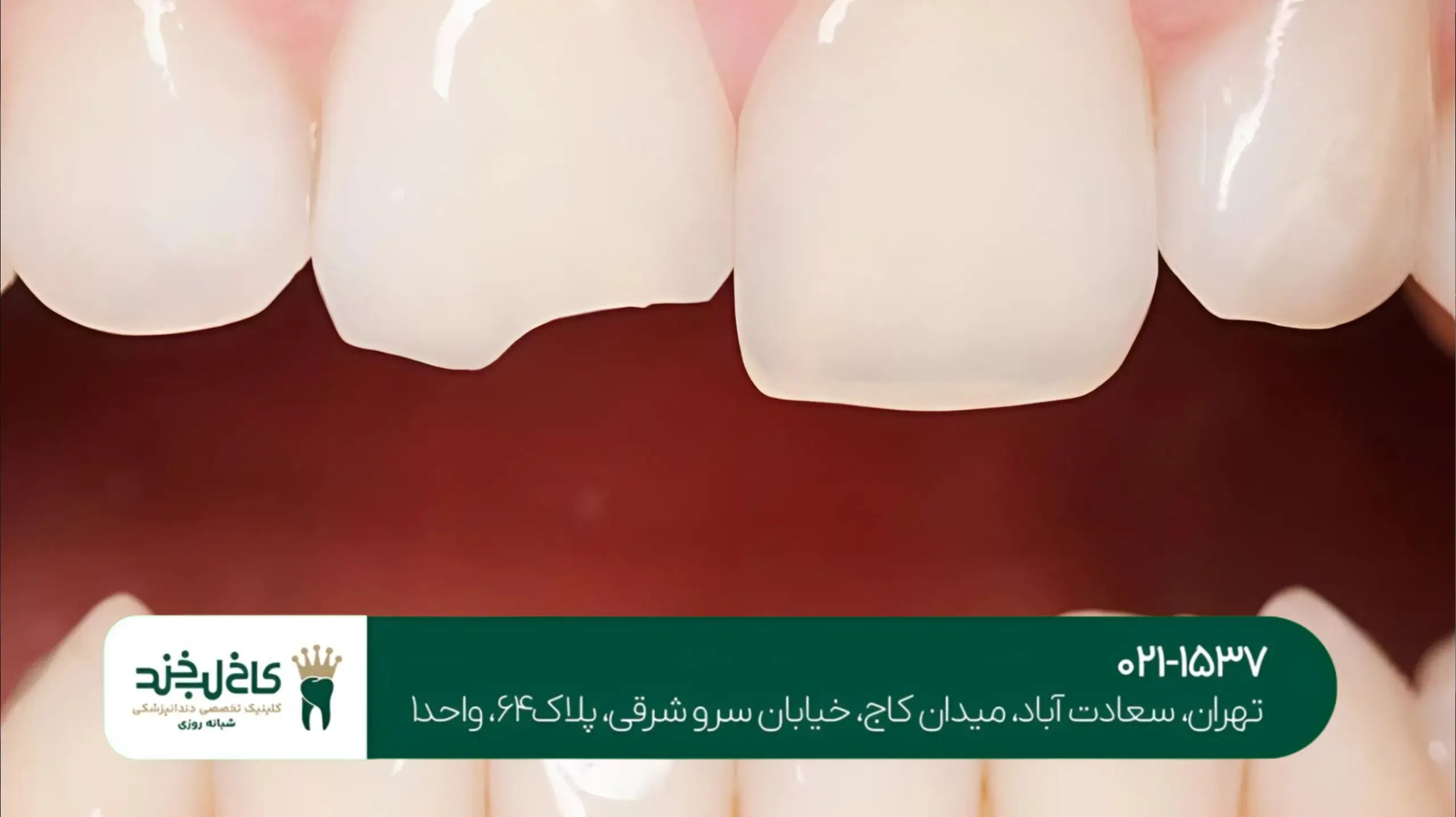 بهترین دندانپزشک لمینت در تهران