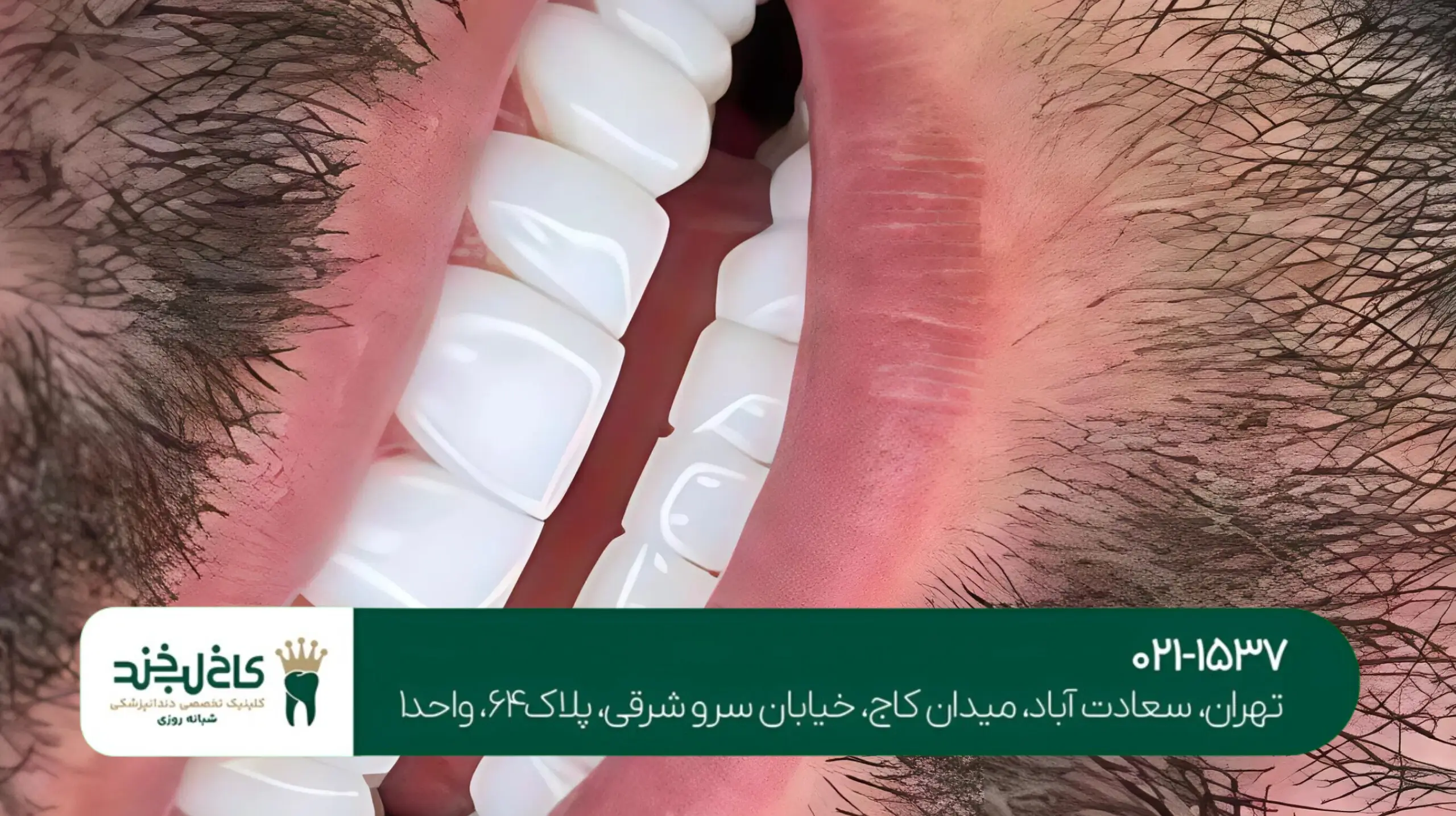 مشاوره رایگان ایمپلنت در تهران